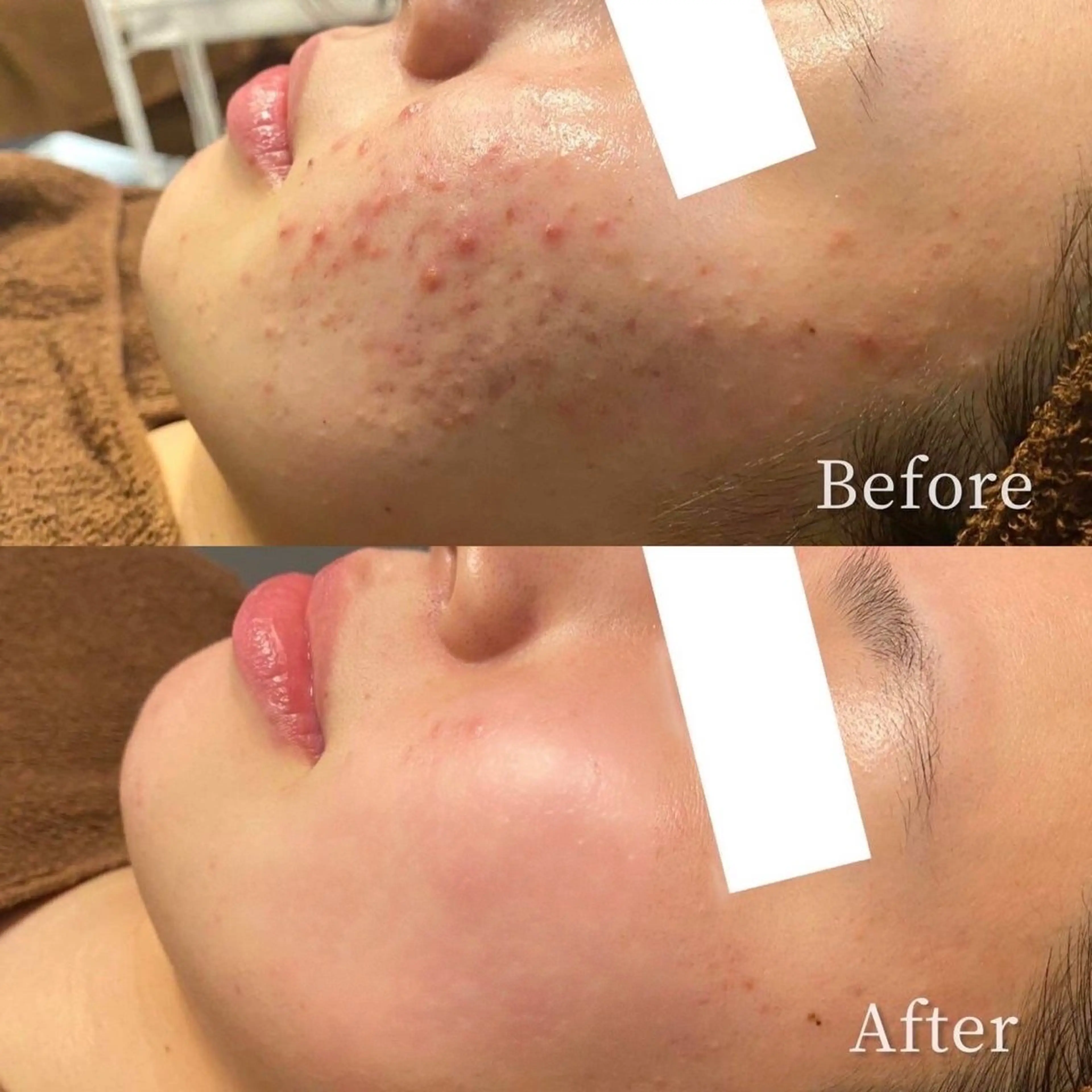 【ニキビ/肌荒れ】最先端美肌機器プラズマシャワー　高濃度美容液導入込み　ネイル同時施術OKの写真