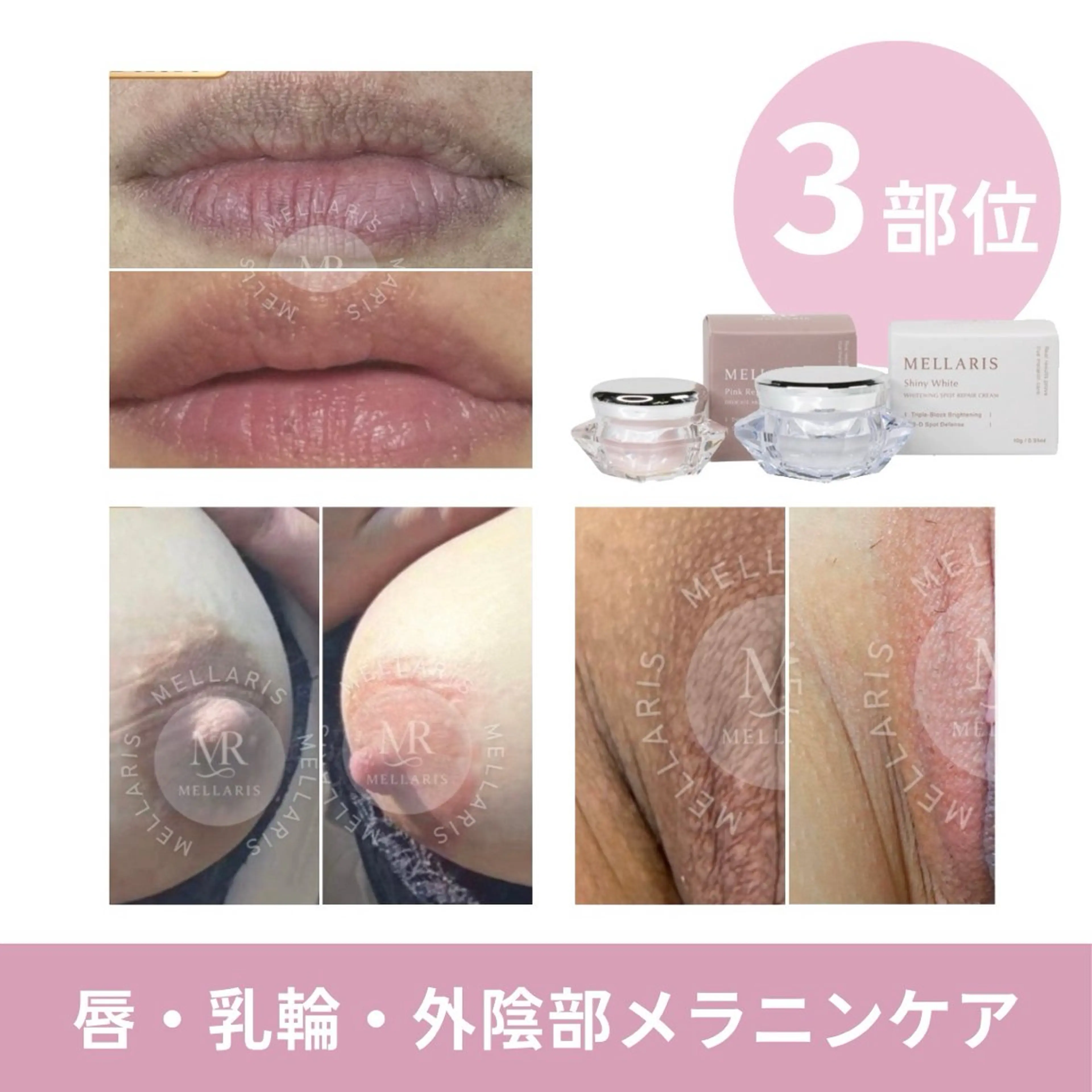 エステ ハーブピーリング肌 管理🌿Ante関内のエステ・リラクイメージ