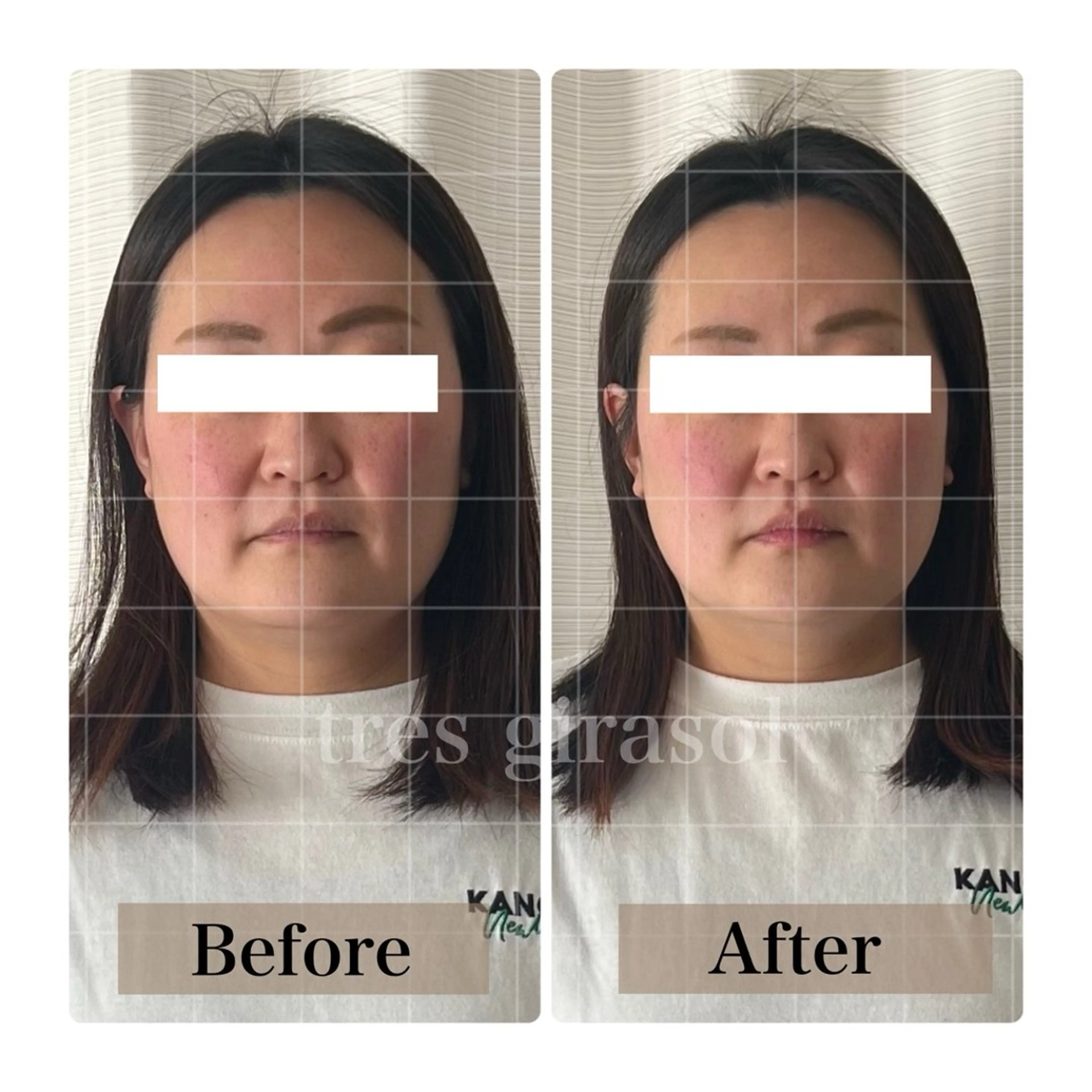 【3名様限定】美骨小顔矯正モニター募集♡の写真