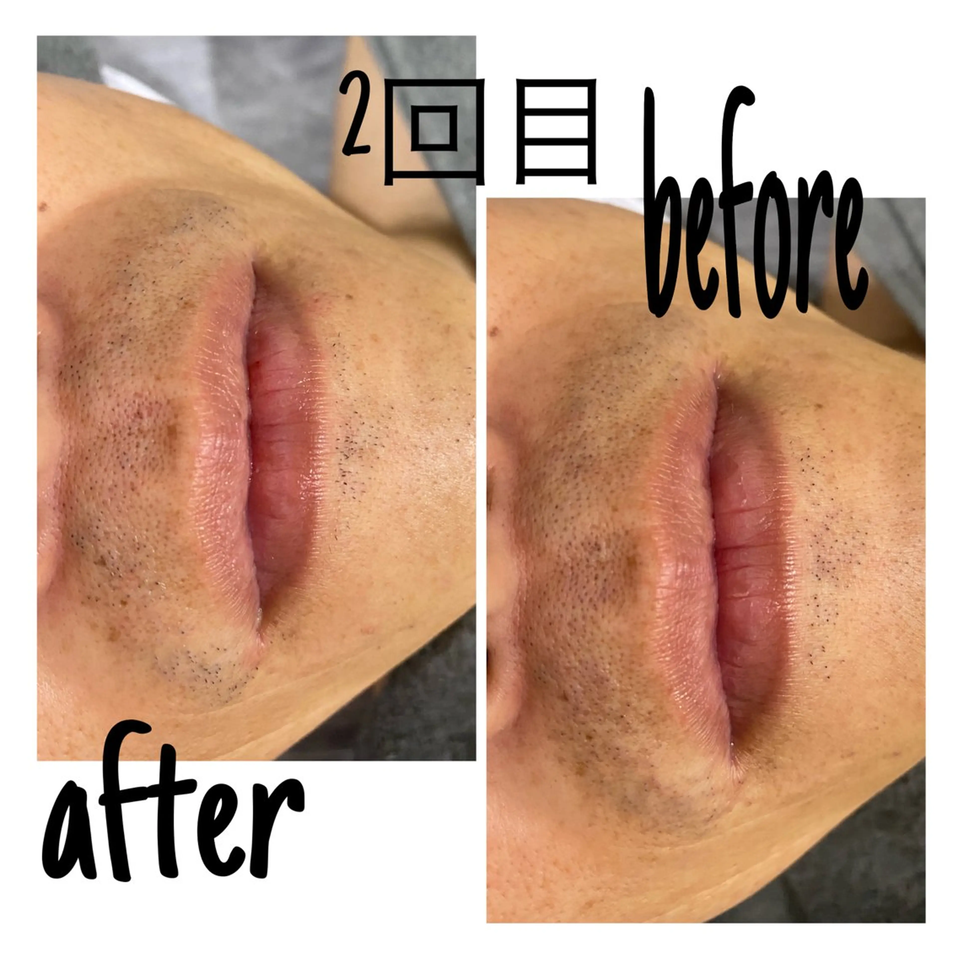 脱毛 毛穴洗浄・痩身・脱毛 /アルカンジュのエステ・リラクイメージ