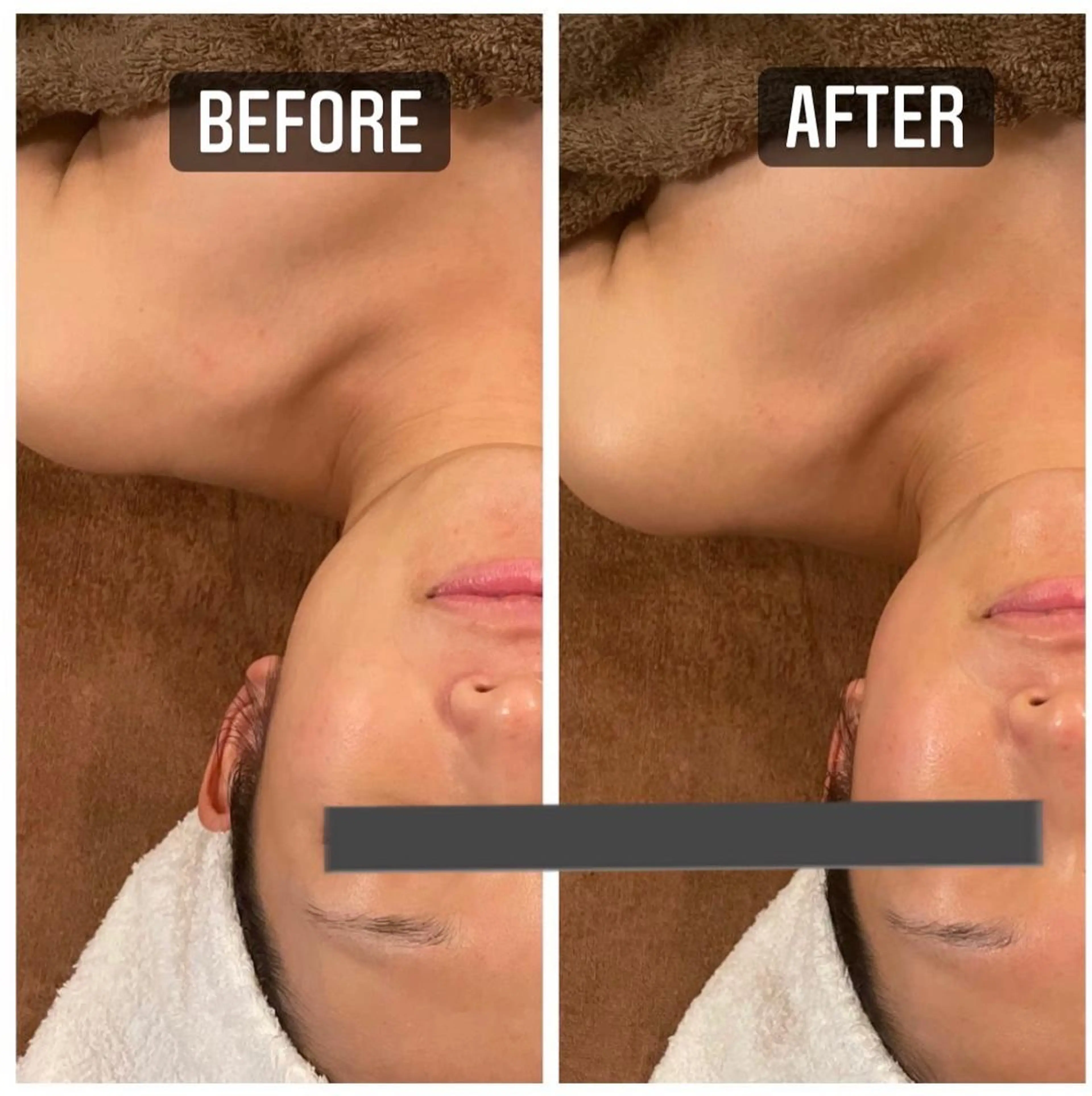 革新的ラジオ波(winback )の写真