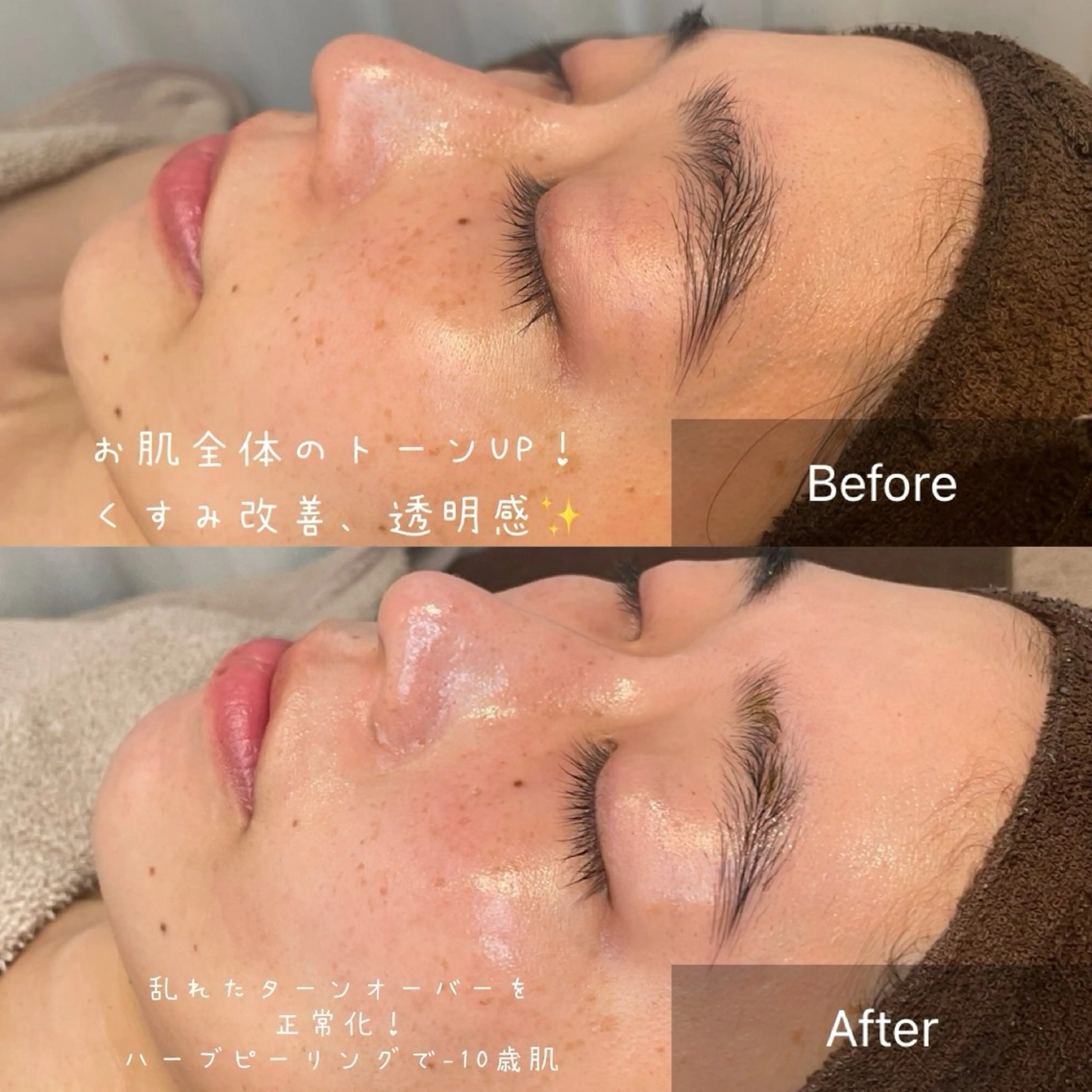 【即効性！エイジング特化】ハーブピーリング＋エイジングケア特化オプション2種付きの写真