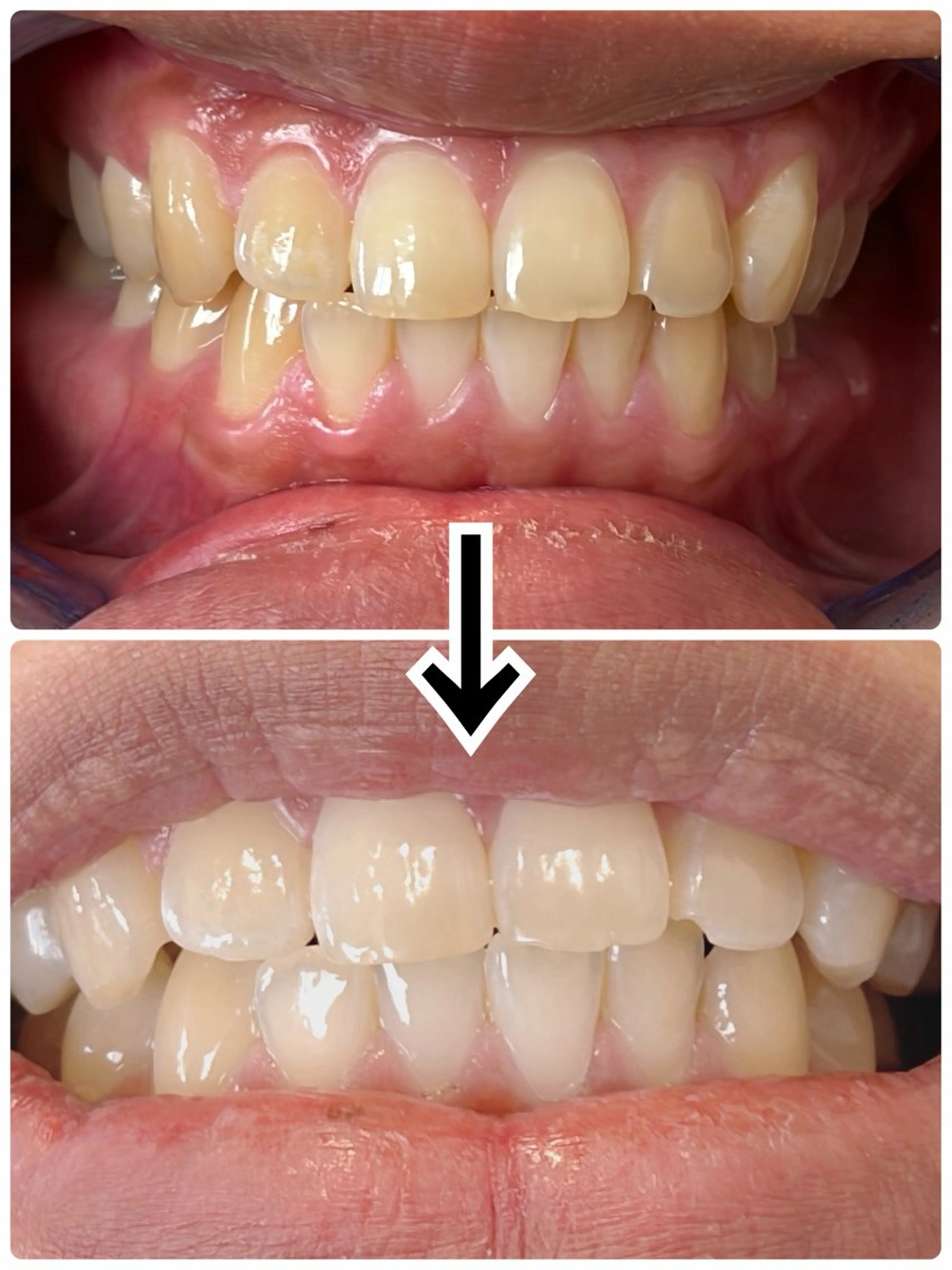 【4w以内のリピーター】歯のセルフホワイトニング🦷サポートあり！15分照射2回で満足な白さに！の写真