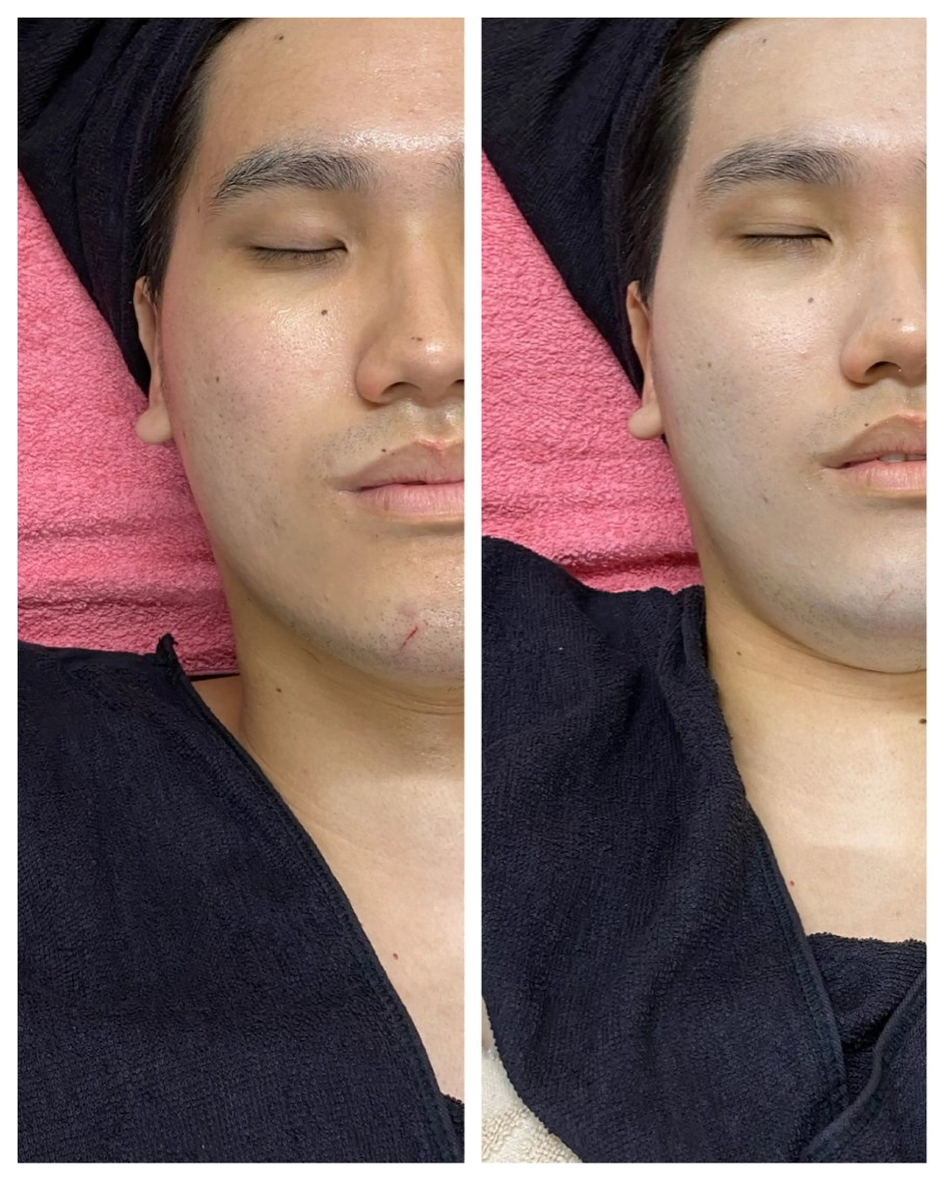 オアシス・さくら所属・小顔（シミ ニキビ）脱毛サロンのエステ・リラクイメージ