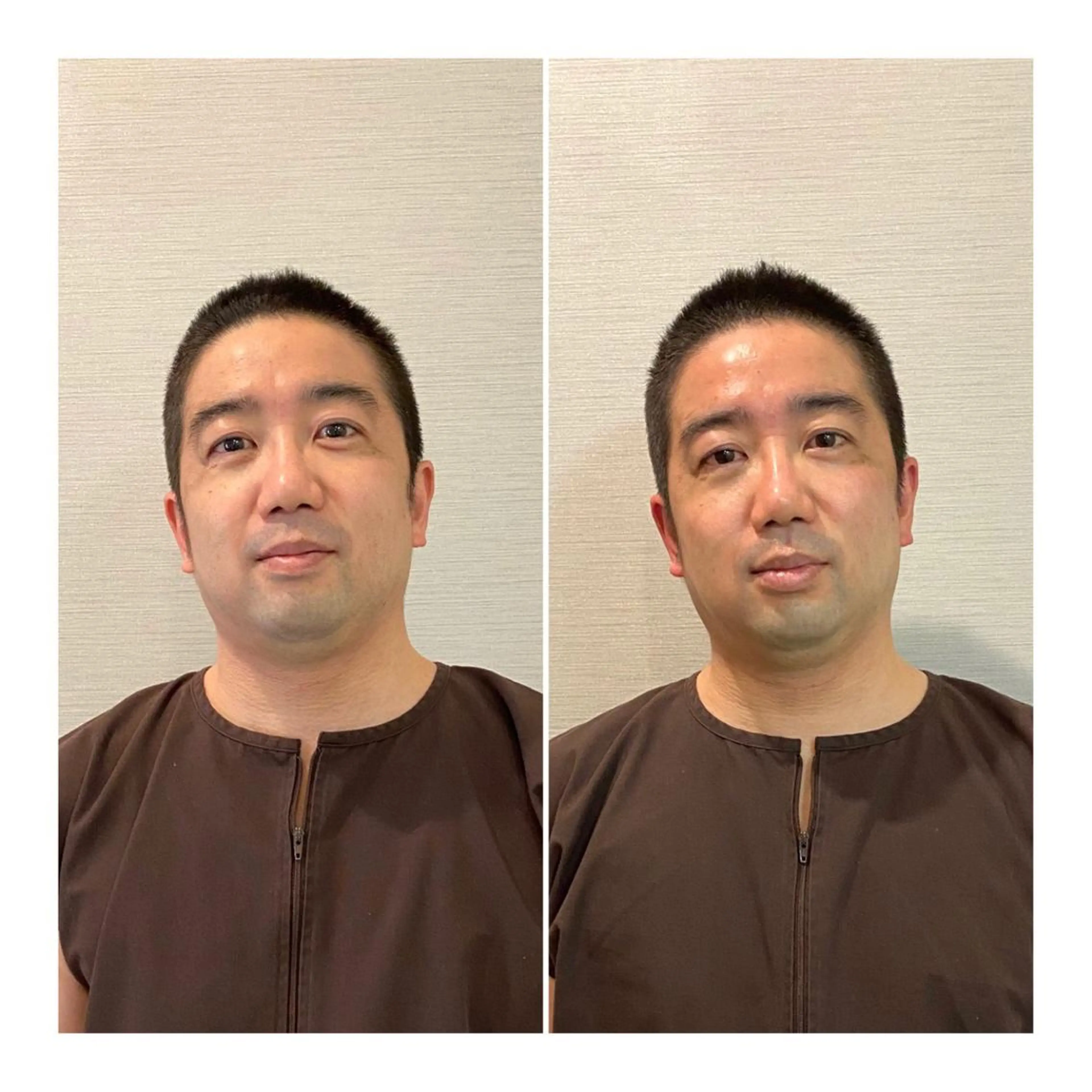 メンズ その他 即小顔♥️美容鍼× ハーブピーリングのその他イメージ