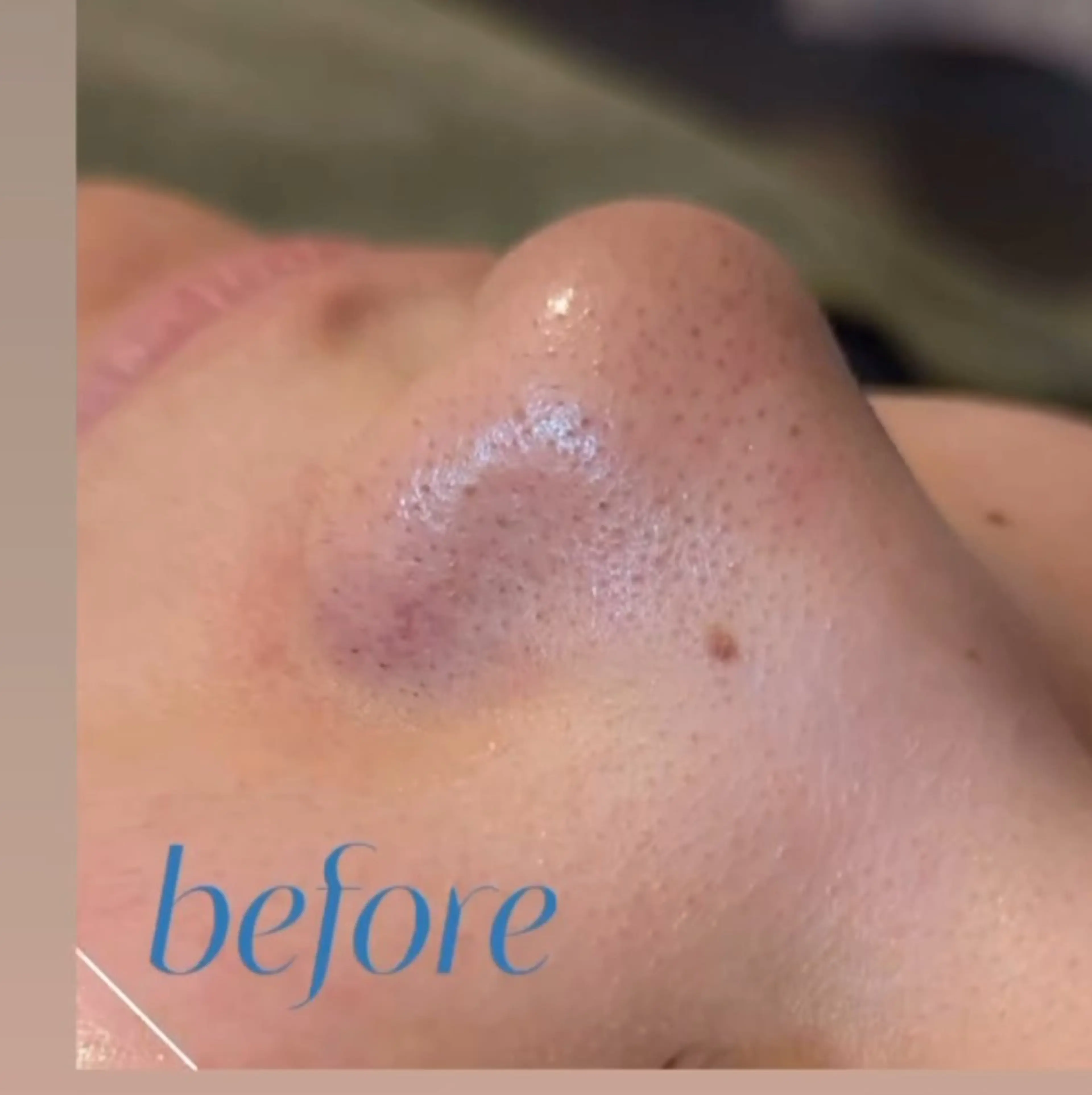 その他 肌質改善BIOELプ ラズマ/ラミピールのエステ・リラクイメージ