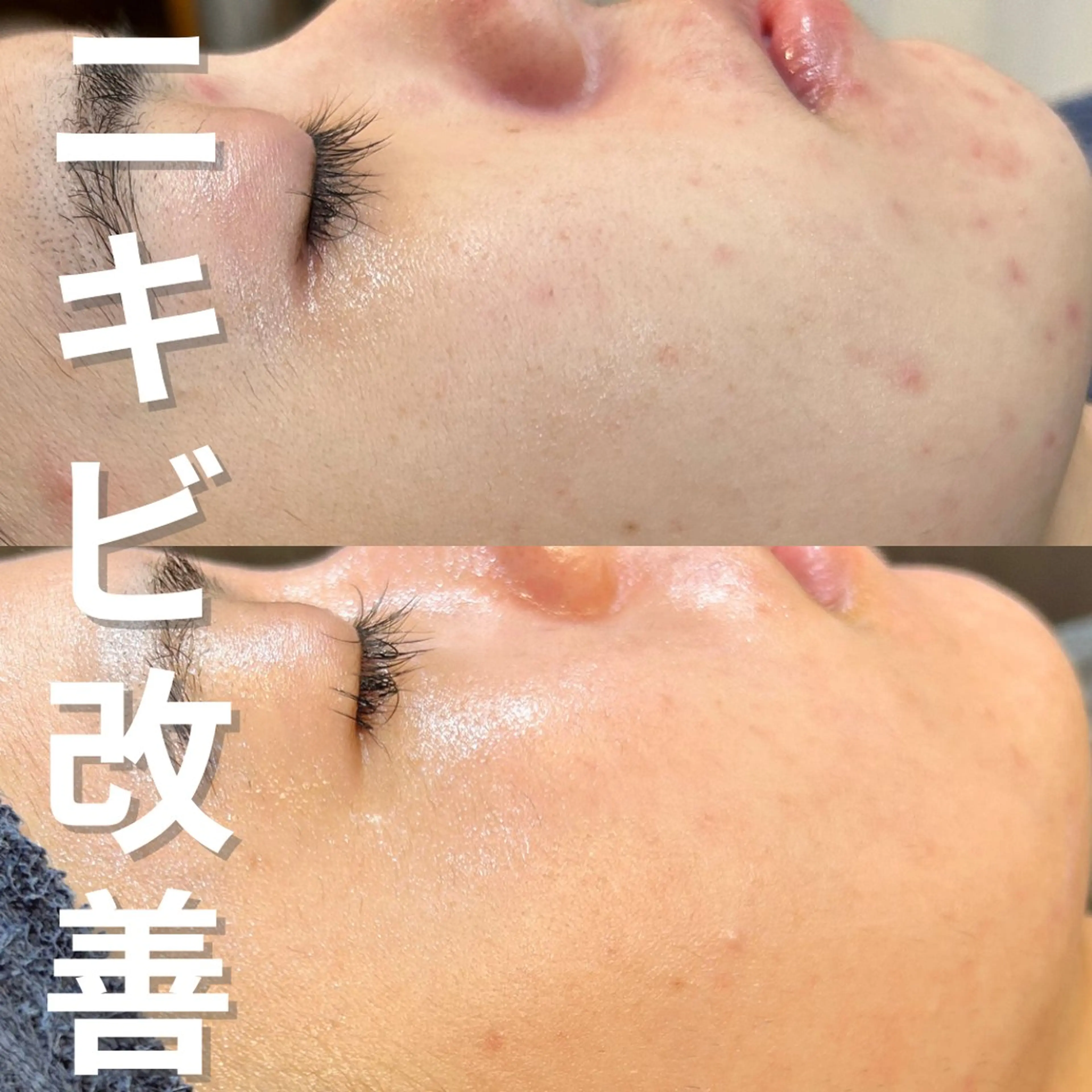 エステ ニキビ・ニキビ跡改善 leoloのエステ・リラクイメージ