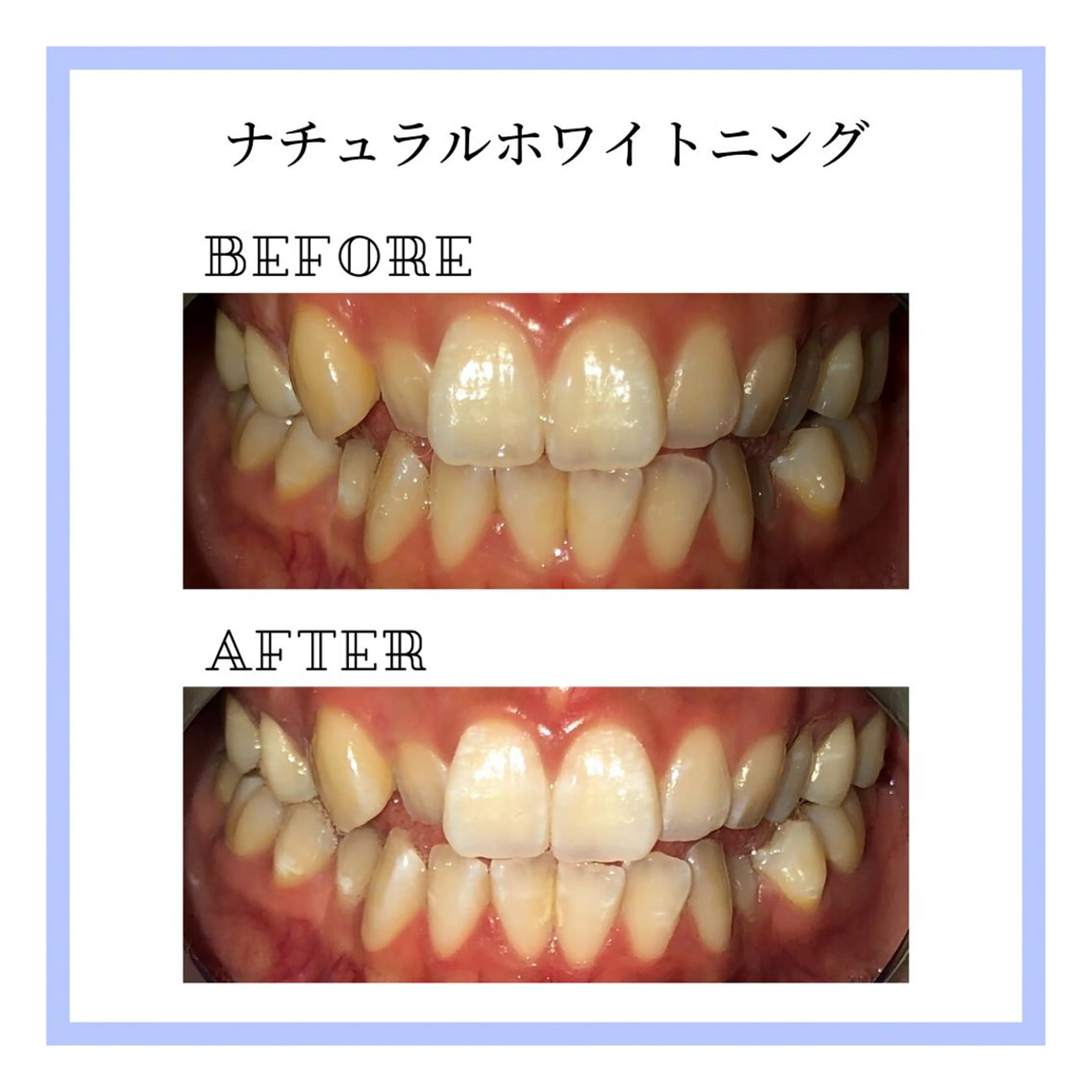 ホワイトニング|韓国式3D毛穴洗浄 lonhana ロンハナ所属・韓国式3D毛穴洗浄 lonhanaのその他イメージ