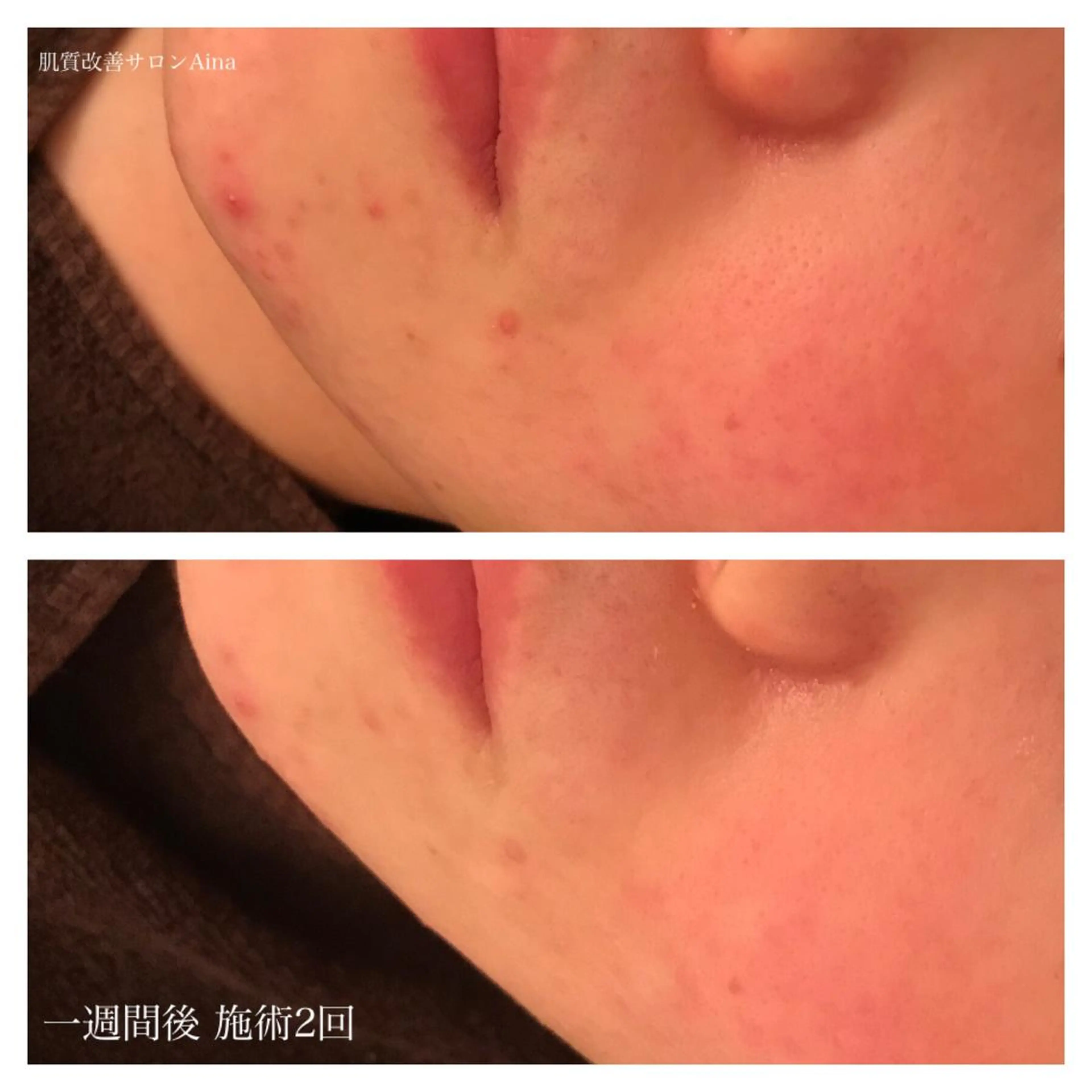 セミロング カラー パーマ ネイル マツエク・マツパ 赤色 エステ リラク ニキビ跡専門サロン Ａｉｎａのエステ・リラクイメージ