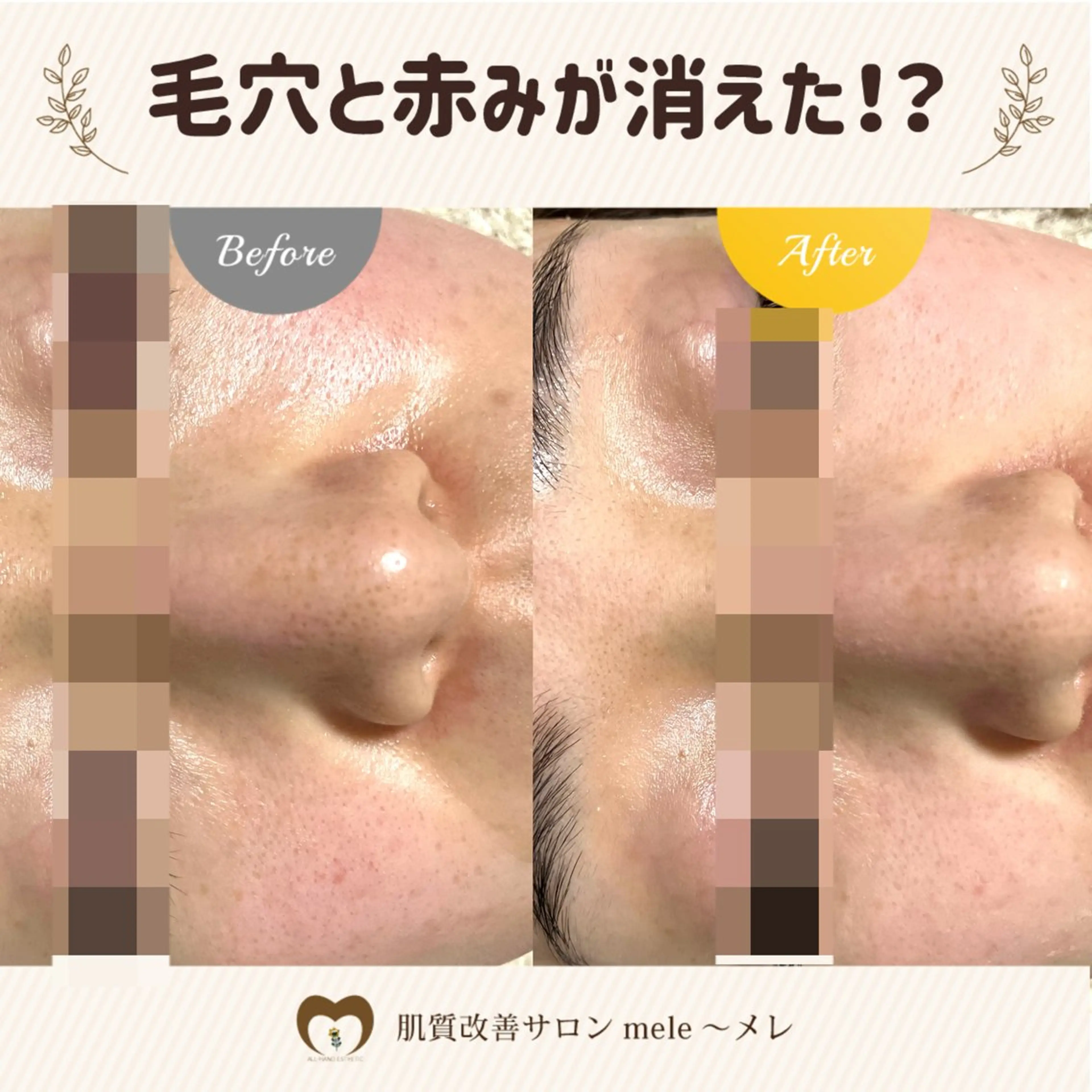 エステ リラク 繰り返すニキビ・毛穴 ✨つくば肌質改善専門のエステ・リラクイメージ