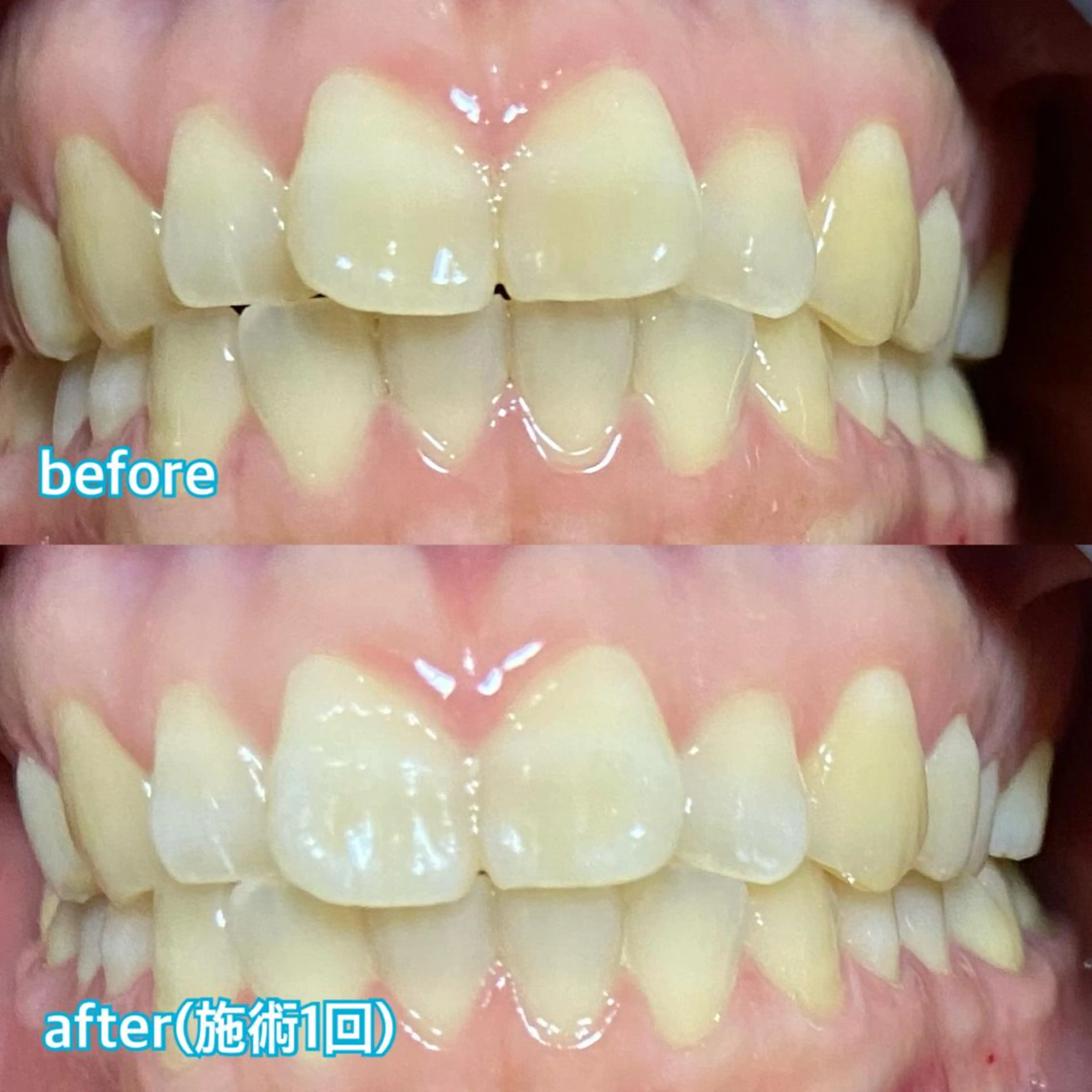 セルフホワイトニングの写真