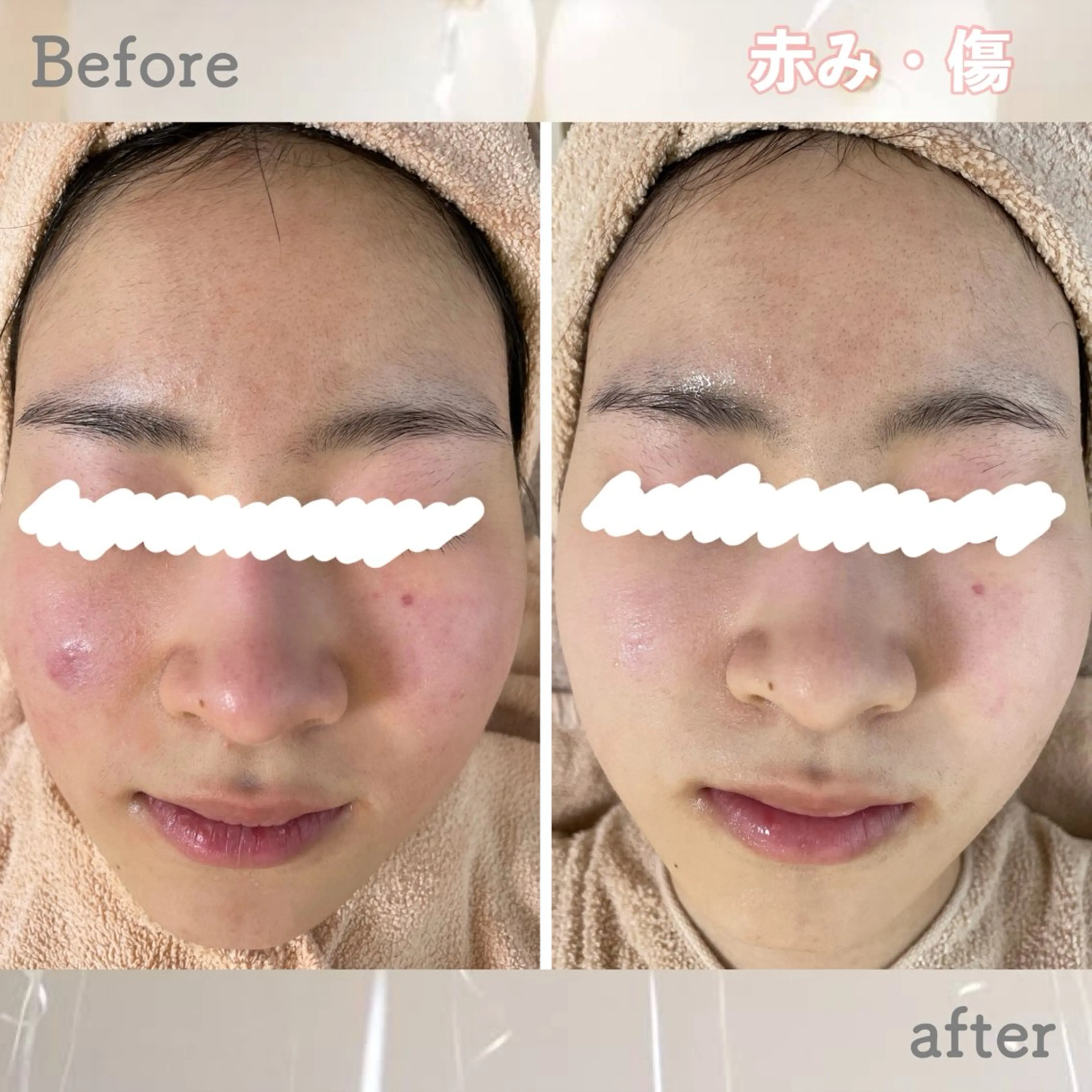 エステ ニキビ&跡改善サロン オーナー光木のエステ・リラクイメージ