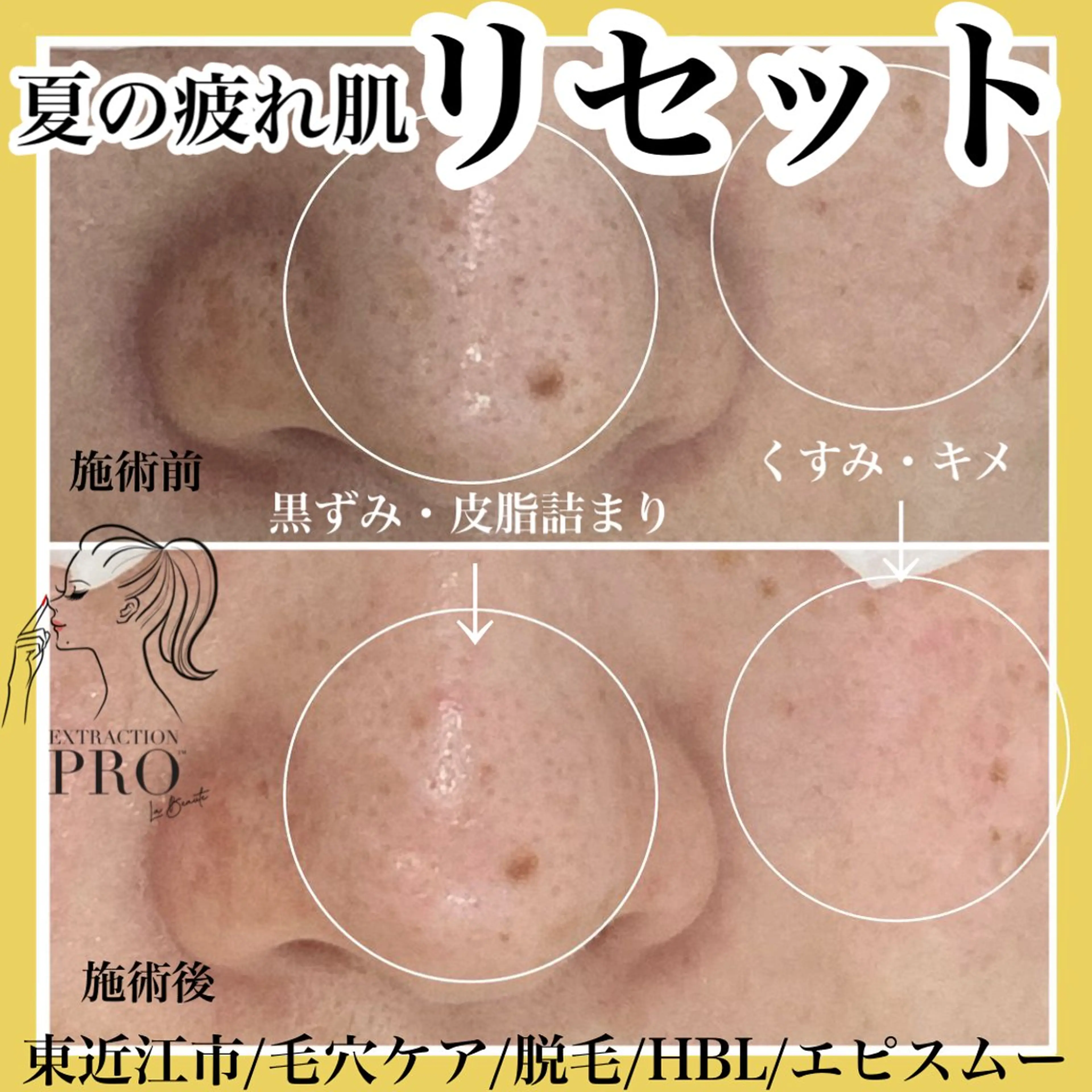 メンズ epismoo 脱毛/HBL/毛穴の眉毛・アイブロウイメージ