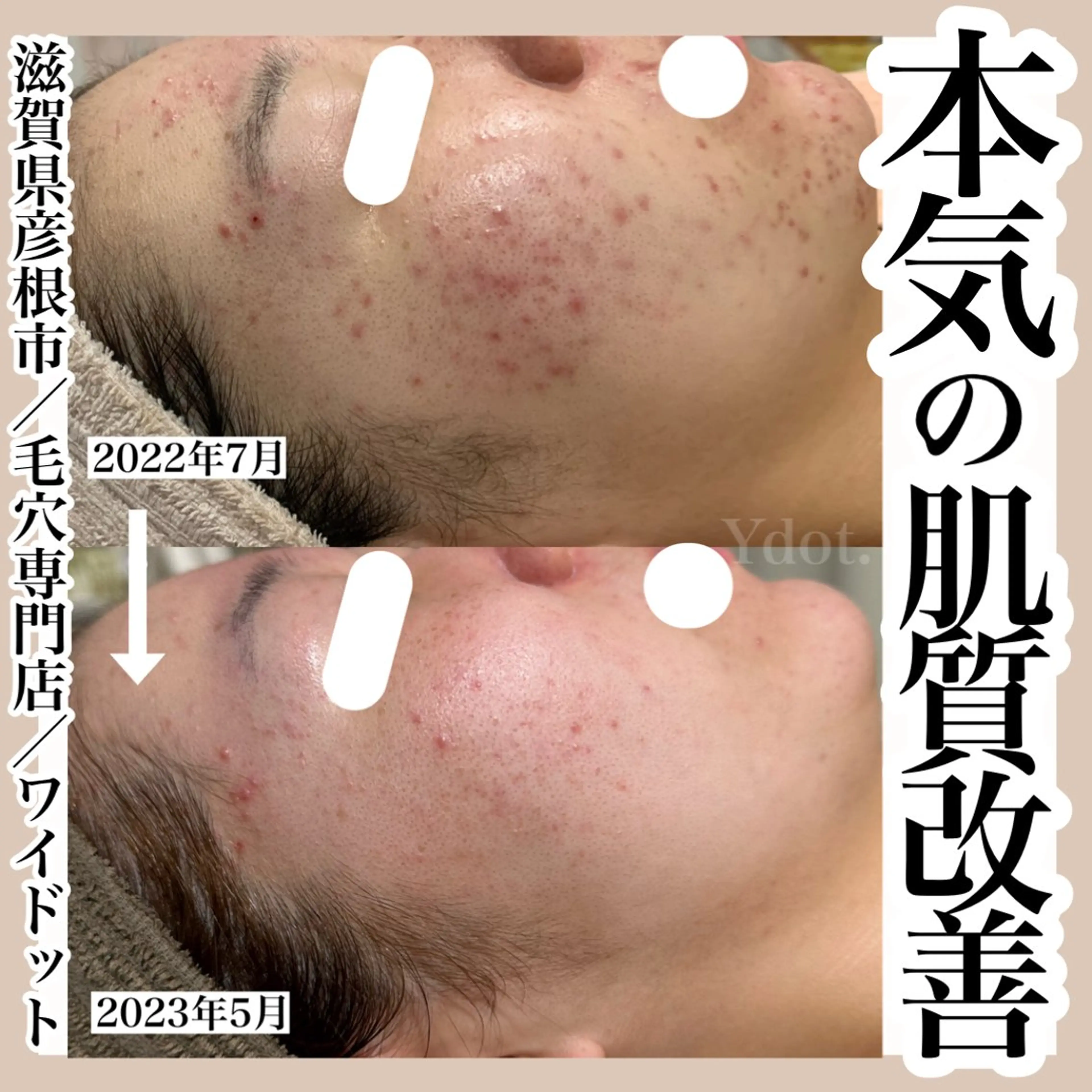 ハーブトリートメントレベル2(剥離あり)の写真