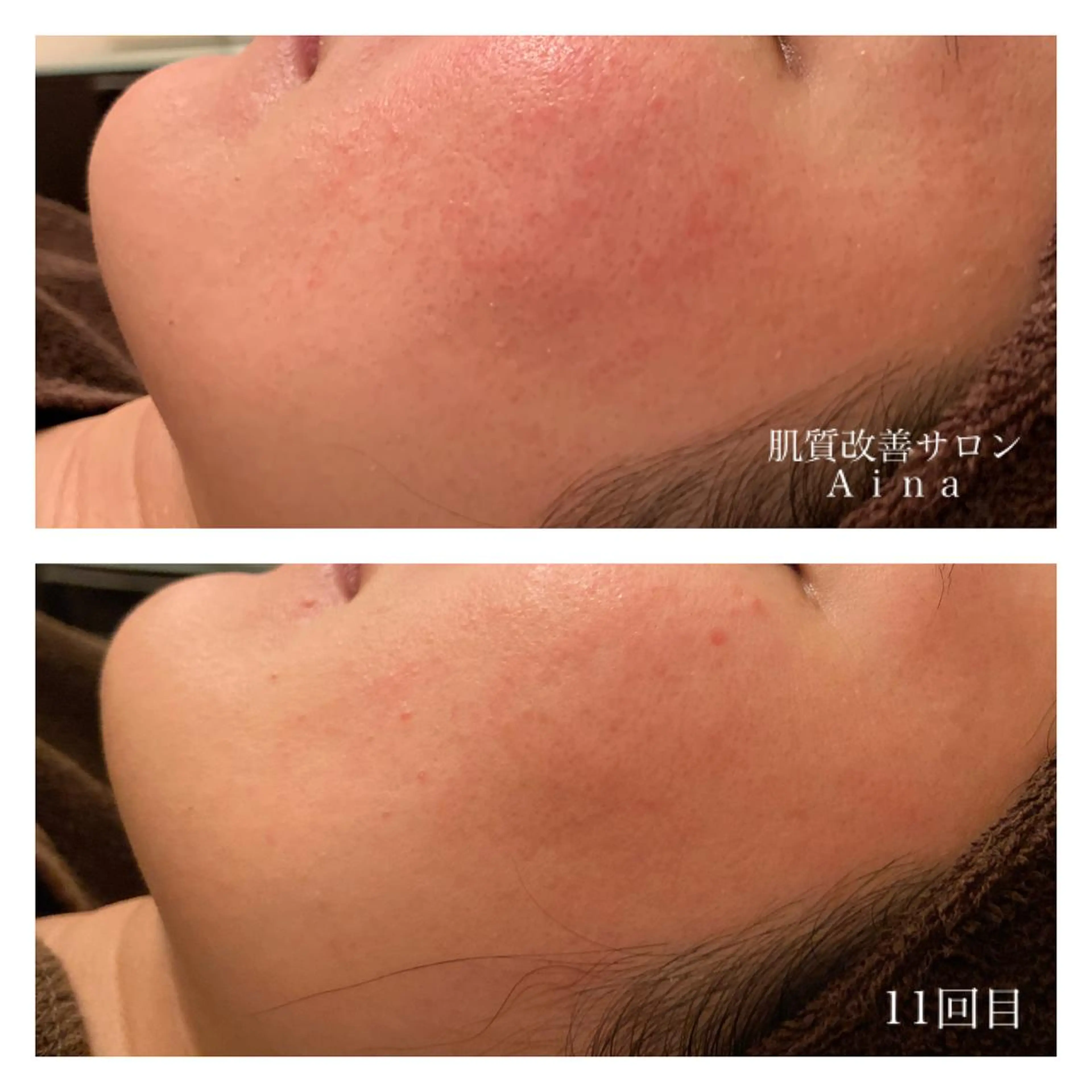 ロング カラー パーマ ヘアアレンジ メンズ キッズ ネイル マツエク・マツパ 赤色 エステ リラク ニキビ跡専門サロン Ａｉｎａのエステ・リラクイメージ