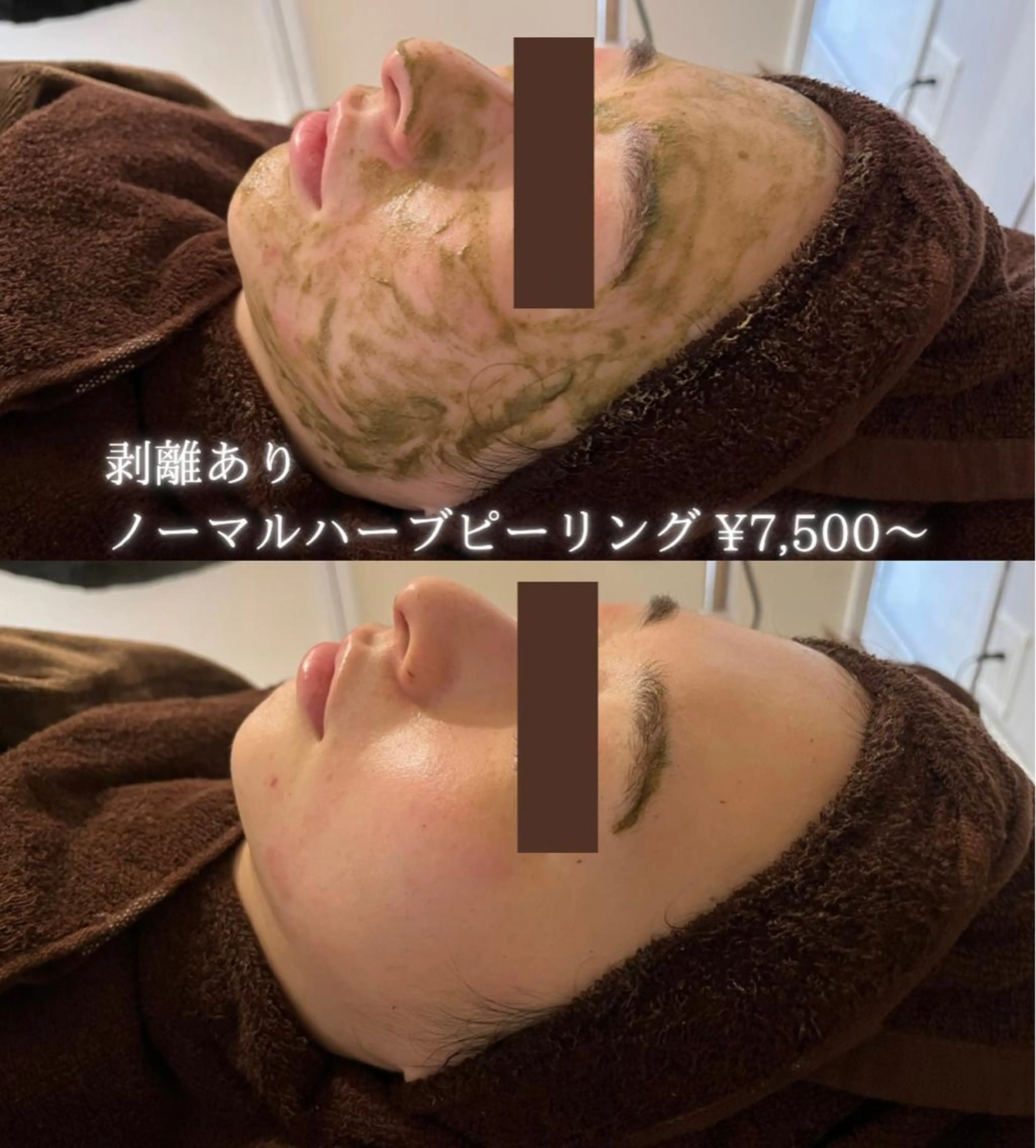 【キャンペーン】剥離ありノーマル・ハーブピーリング 🌿薄皮程度の皮剥けありダウンタイム3〜5日間あり✨の写真