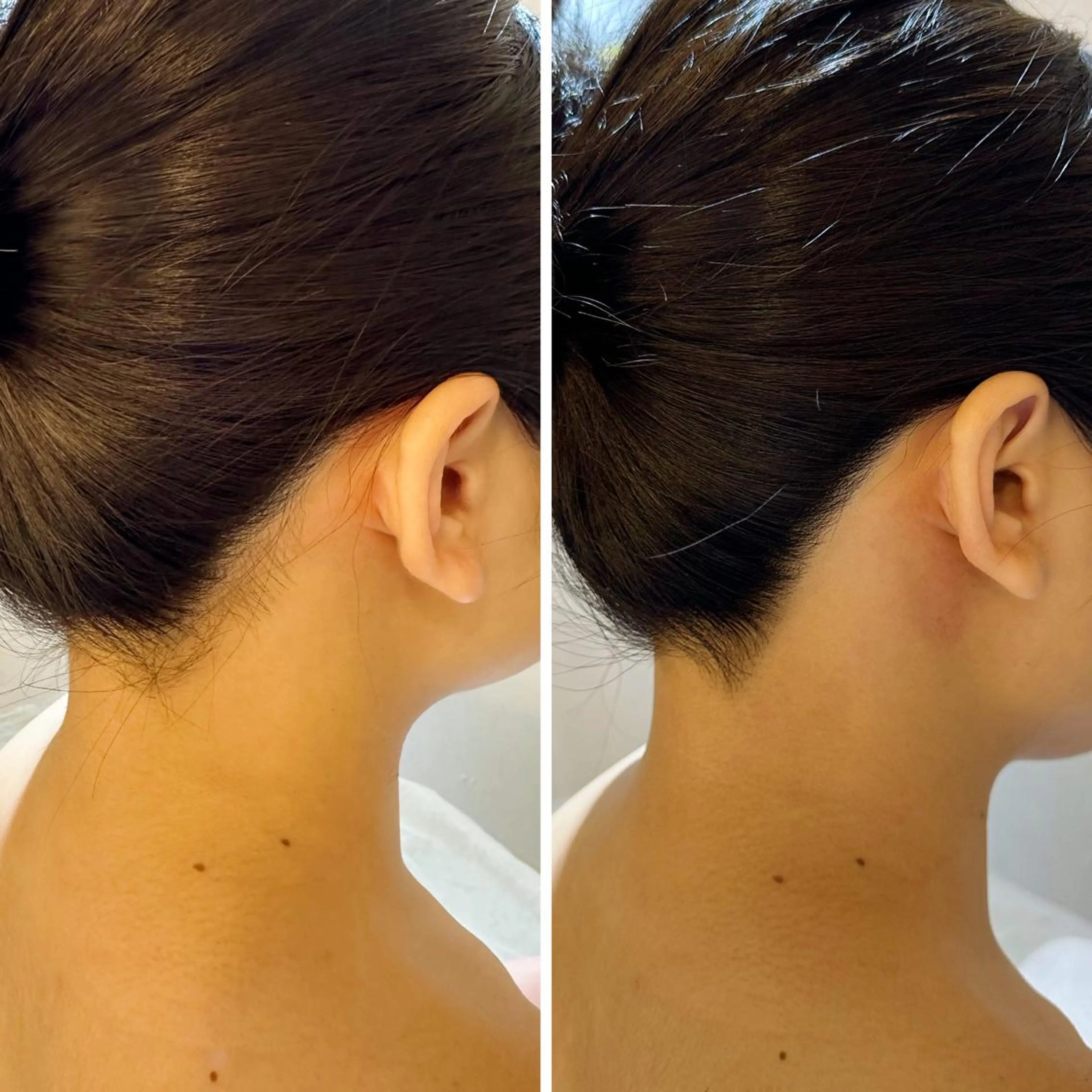 脱毛 うなじ脱毛/美肌脱毛 LABELのエステ・リラクイメージ