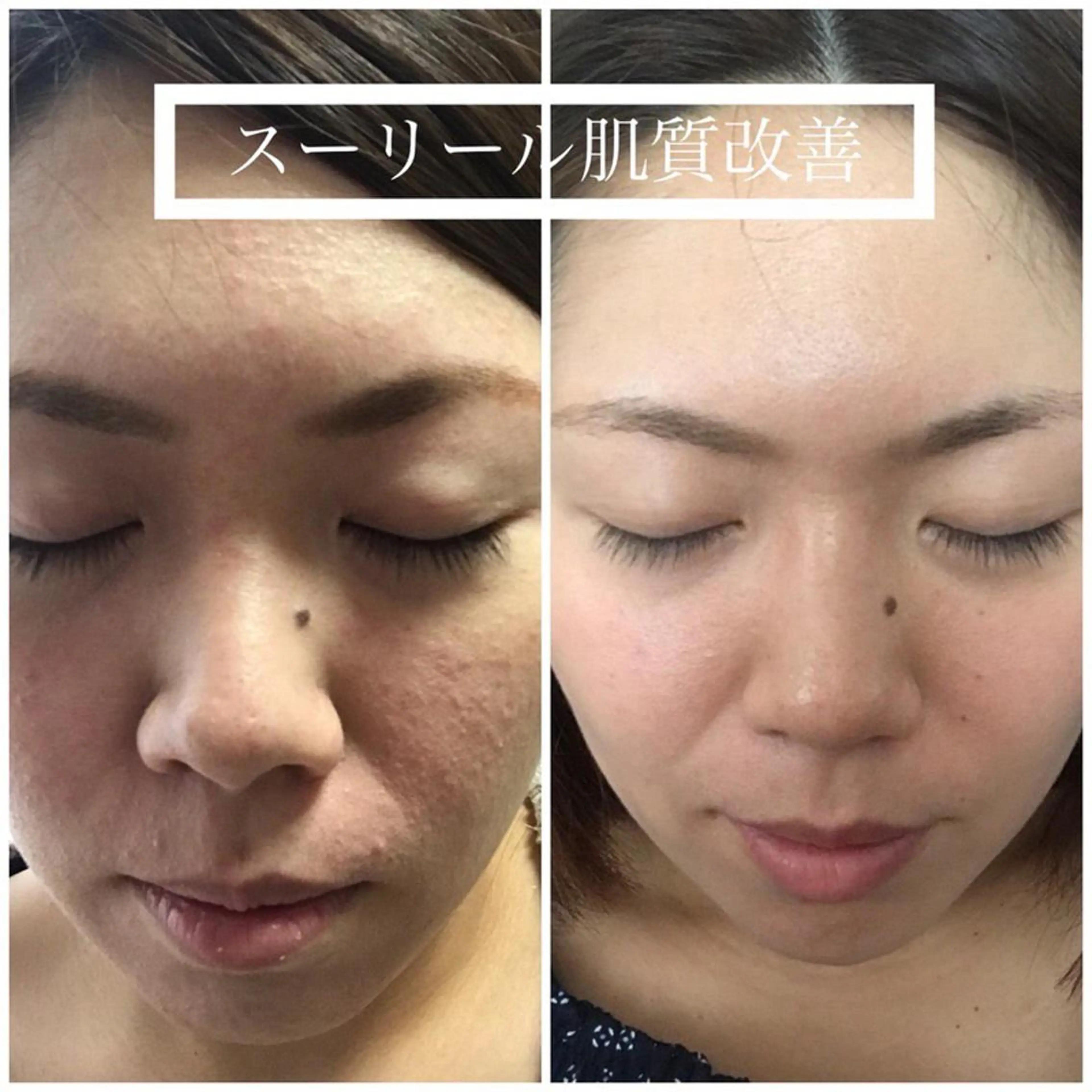 エステ 肌荒れに悩む方のため オイルフリーサロンのマツエク・マツパデザイン