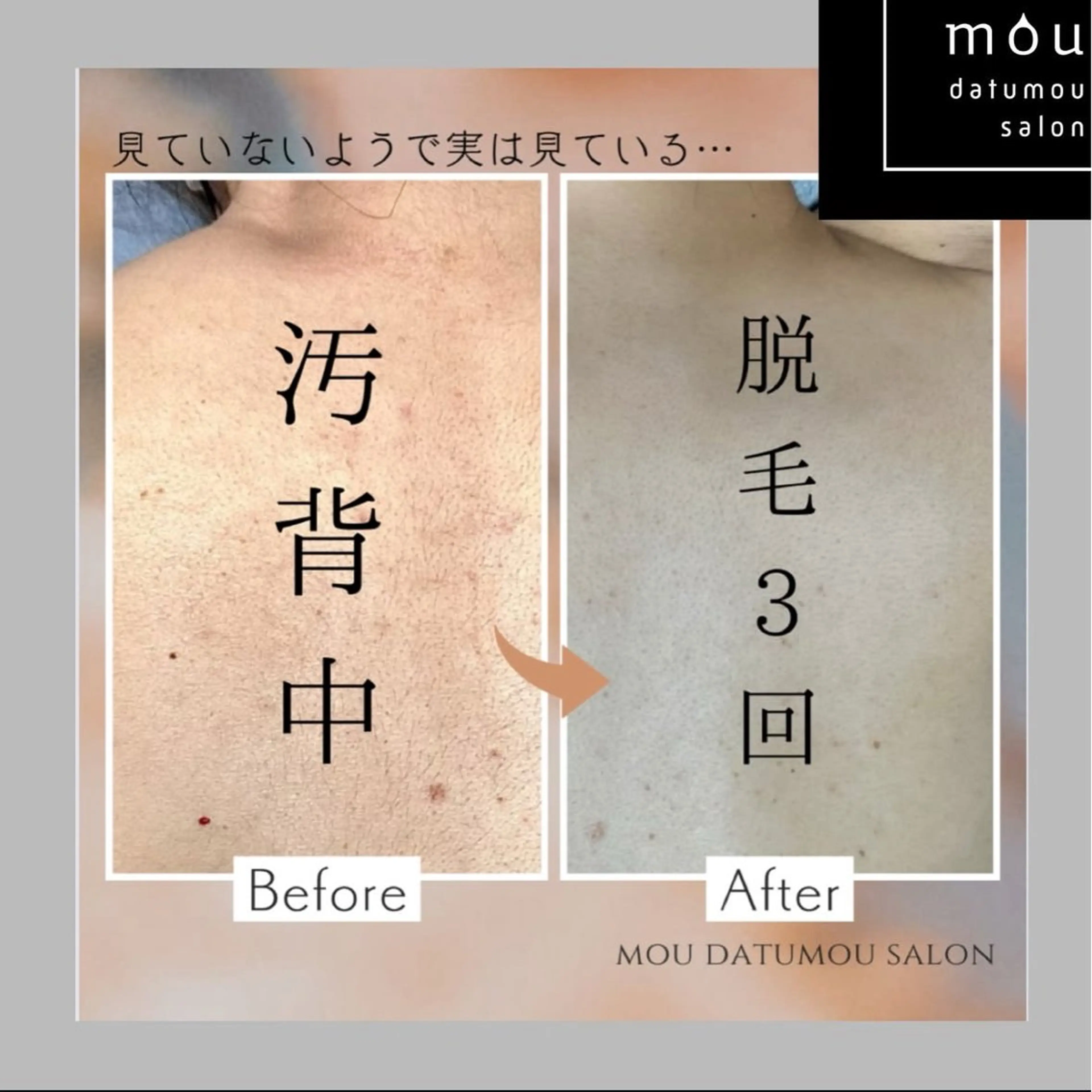 🚺限定❗️脱毛士による丁寧な背中脱毛🥼他店で抜けなかった方、初めての方はこちら💁丁寧なカウンセリング込みです🤓の写真