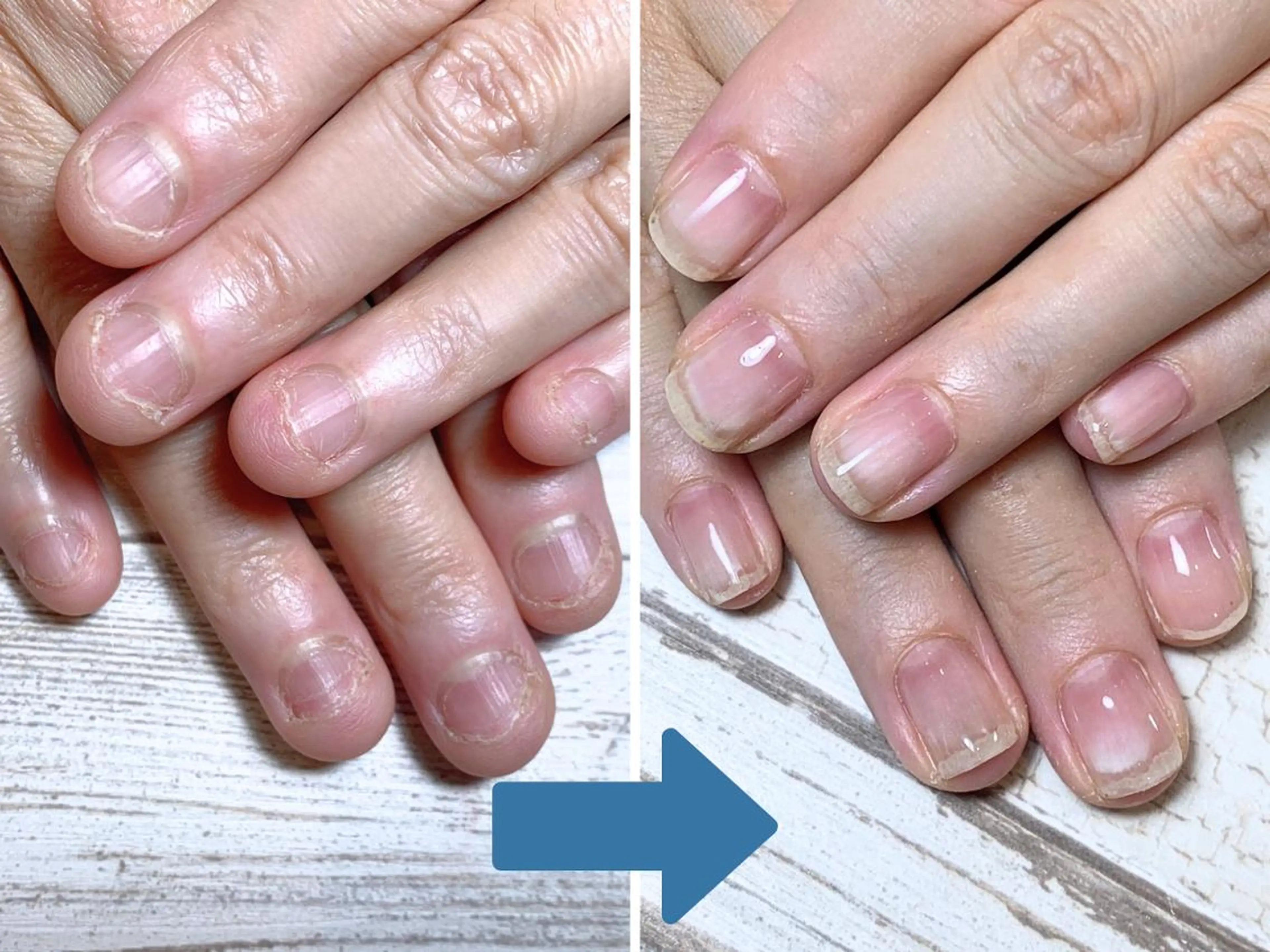 ネイル 深爪矯正・自爪育成 ネイルサロンアモまいのネイルデザイン