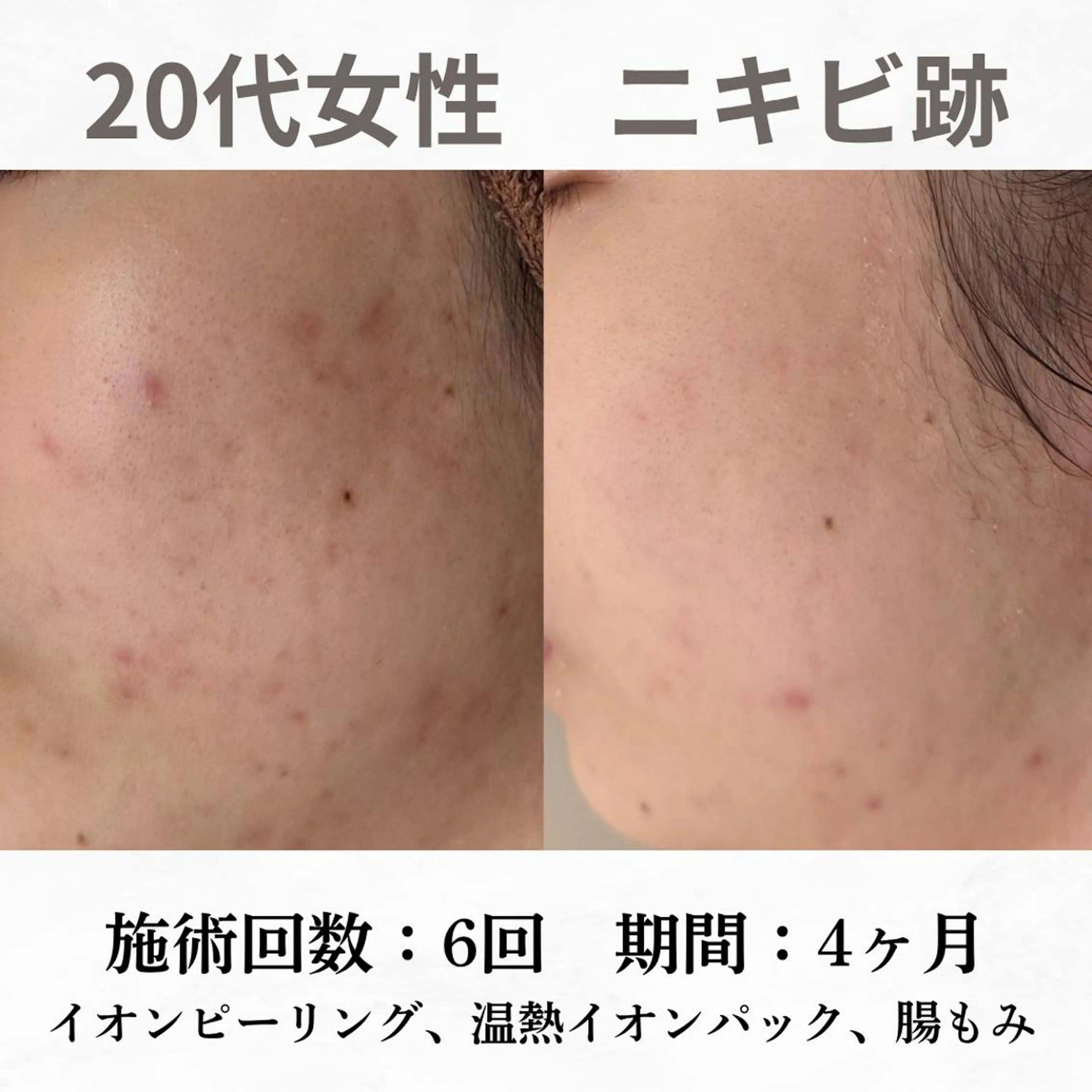 重度ニキビ専門🌷 ダウンタイムなしのエステ・リラクイメージ