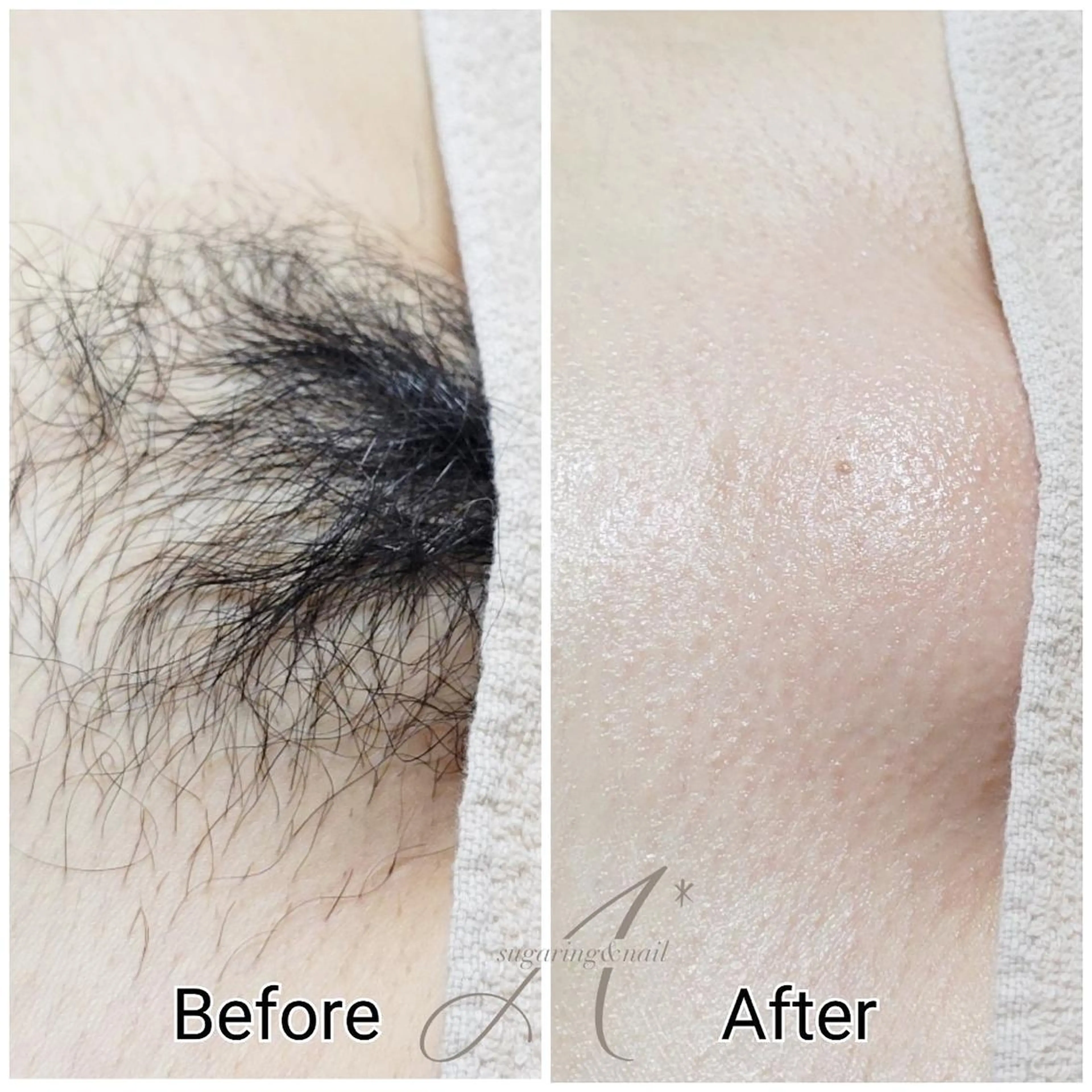 VIO シュガーリング🍋脱毛【ご新規様】の写真