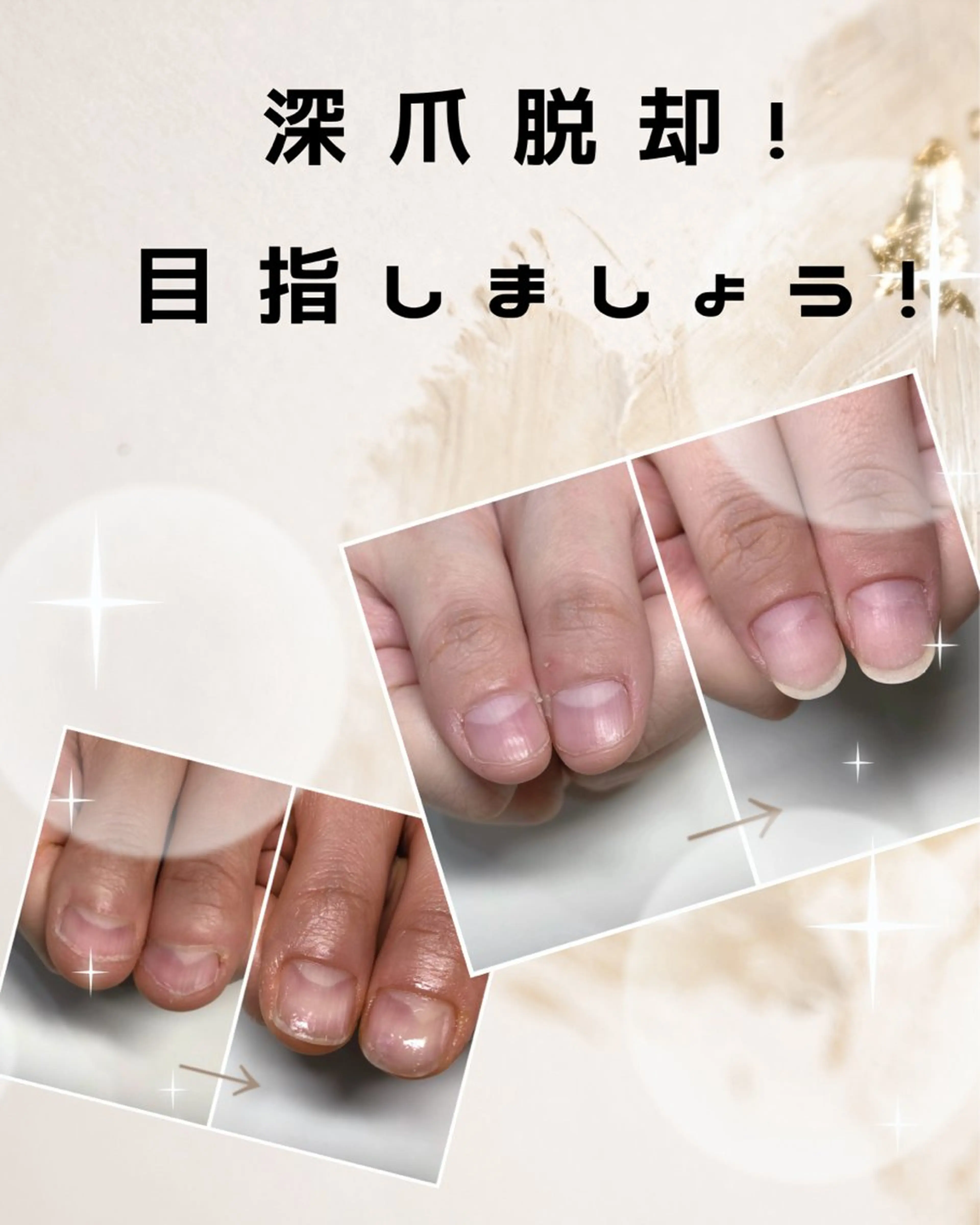 ネイル 深爪矯正・自爪育成 ヴェールリムのネイルデザイン