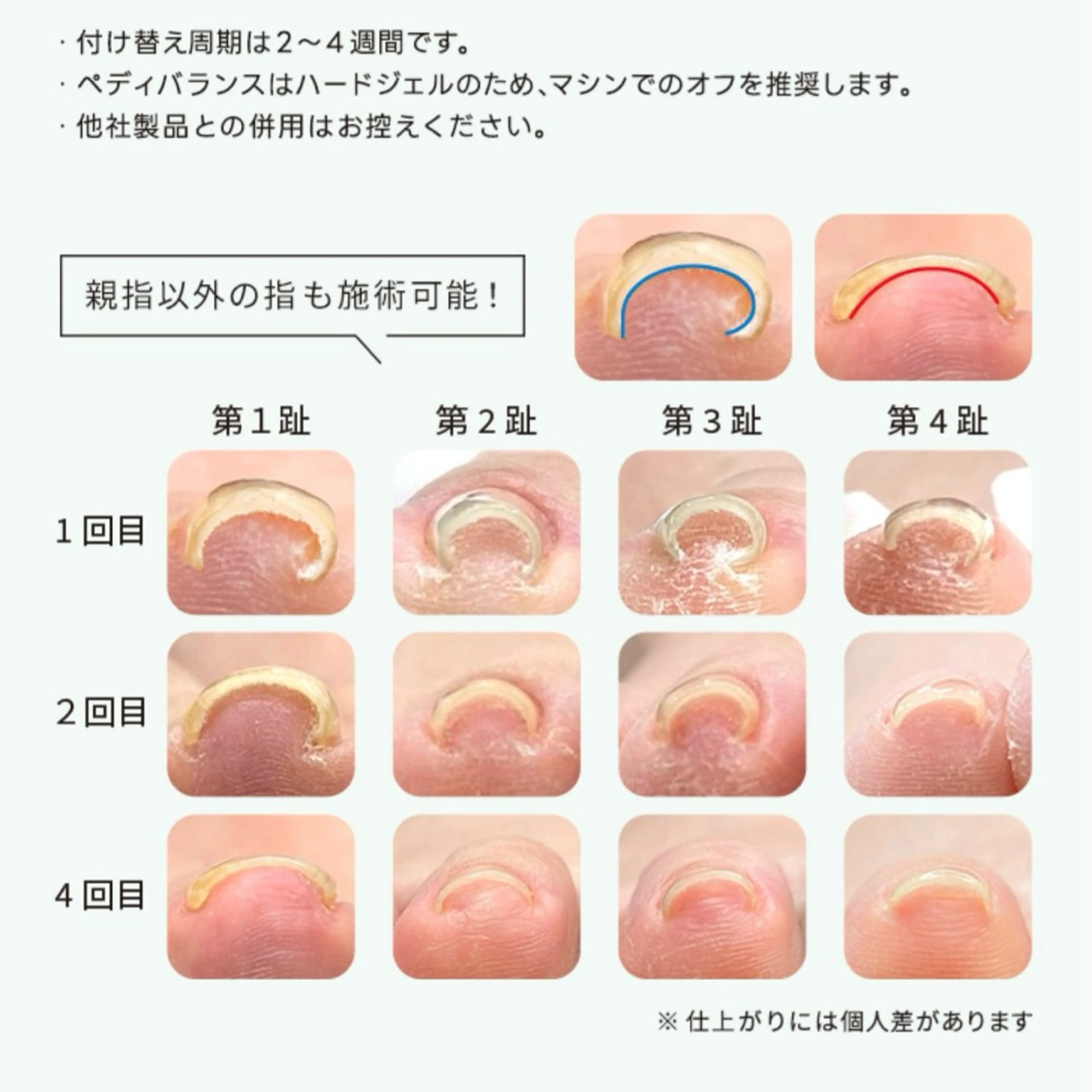 痛くない巻き爪改善ネイル👣 (オフ+¥500)の写真