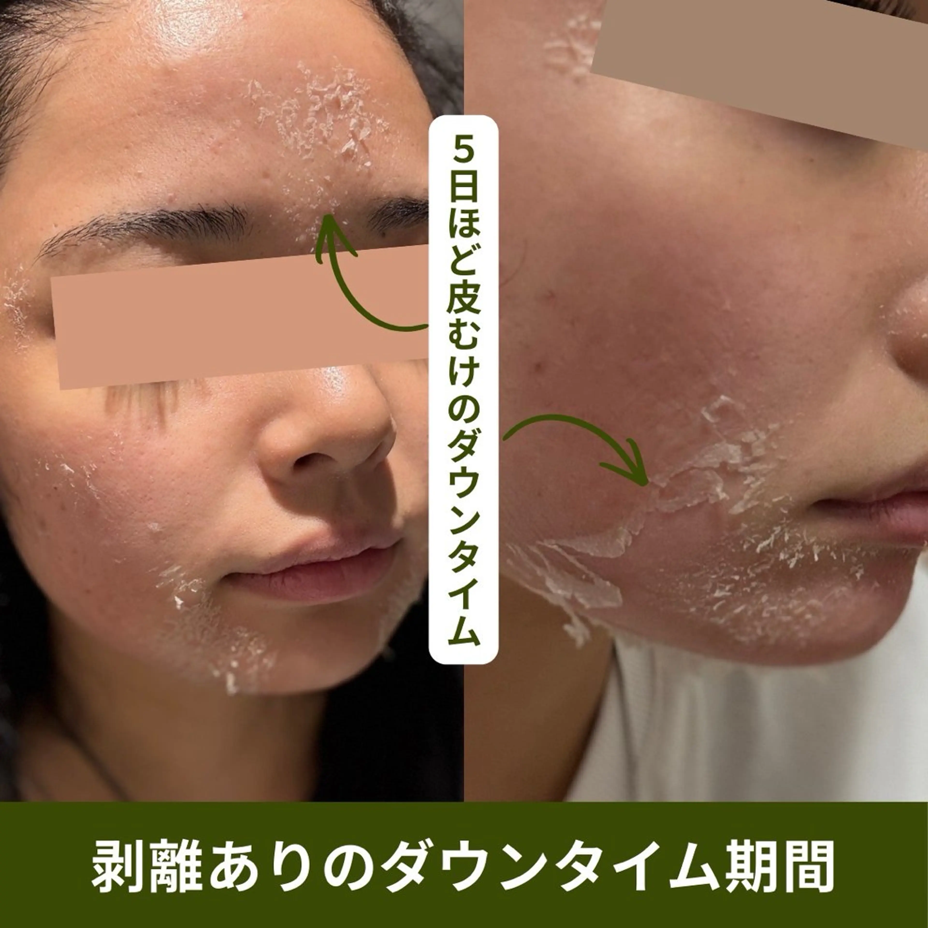 エステ ハーブピーリング肌 管理🌿Ante関内のエステ・リラクイメージ