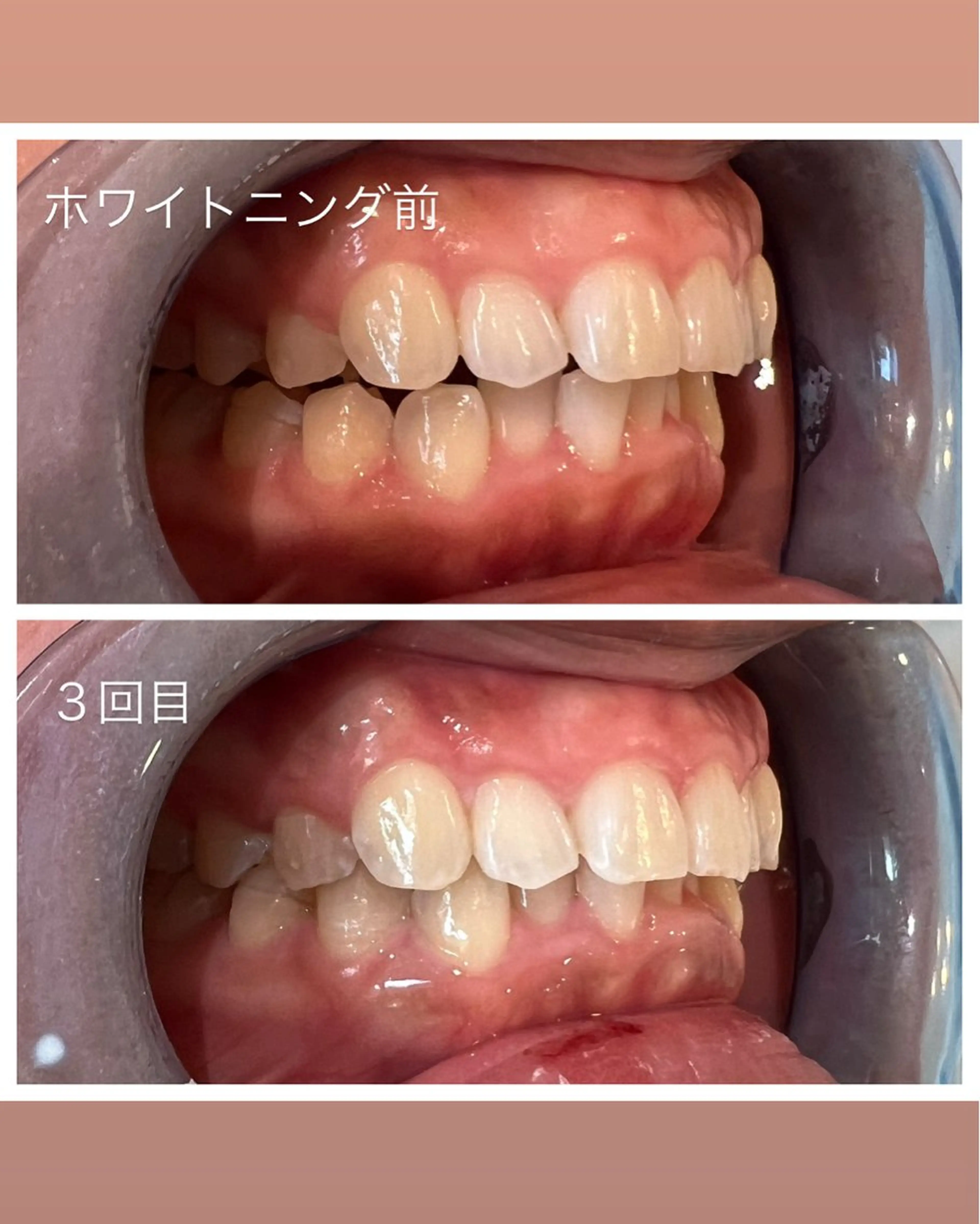 セルフホワイトニング Shineeのエステ・リラクイメージ