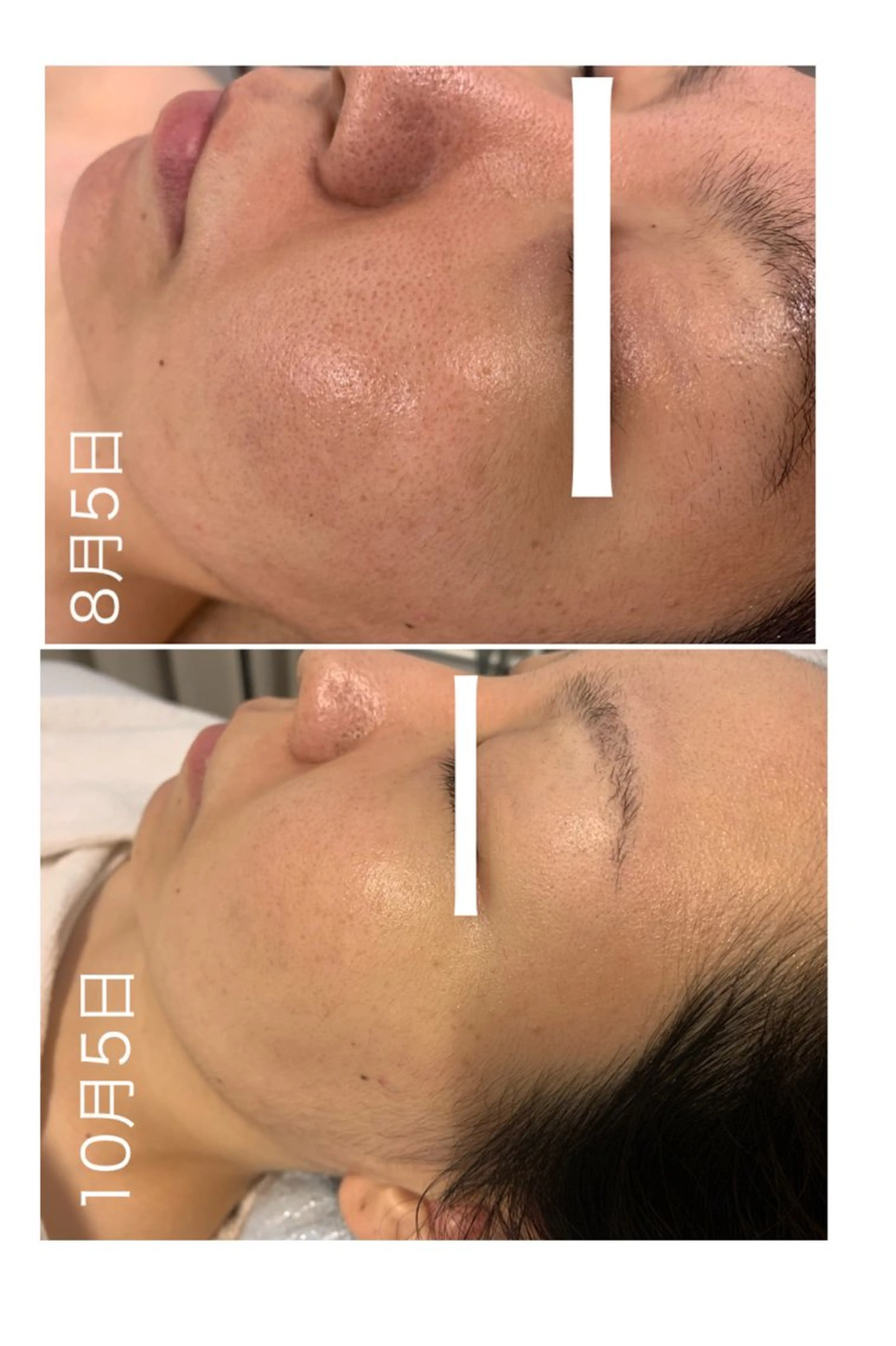 【minimo限定価格】毛穴引き締め透明感のある肌に🫧の写真