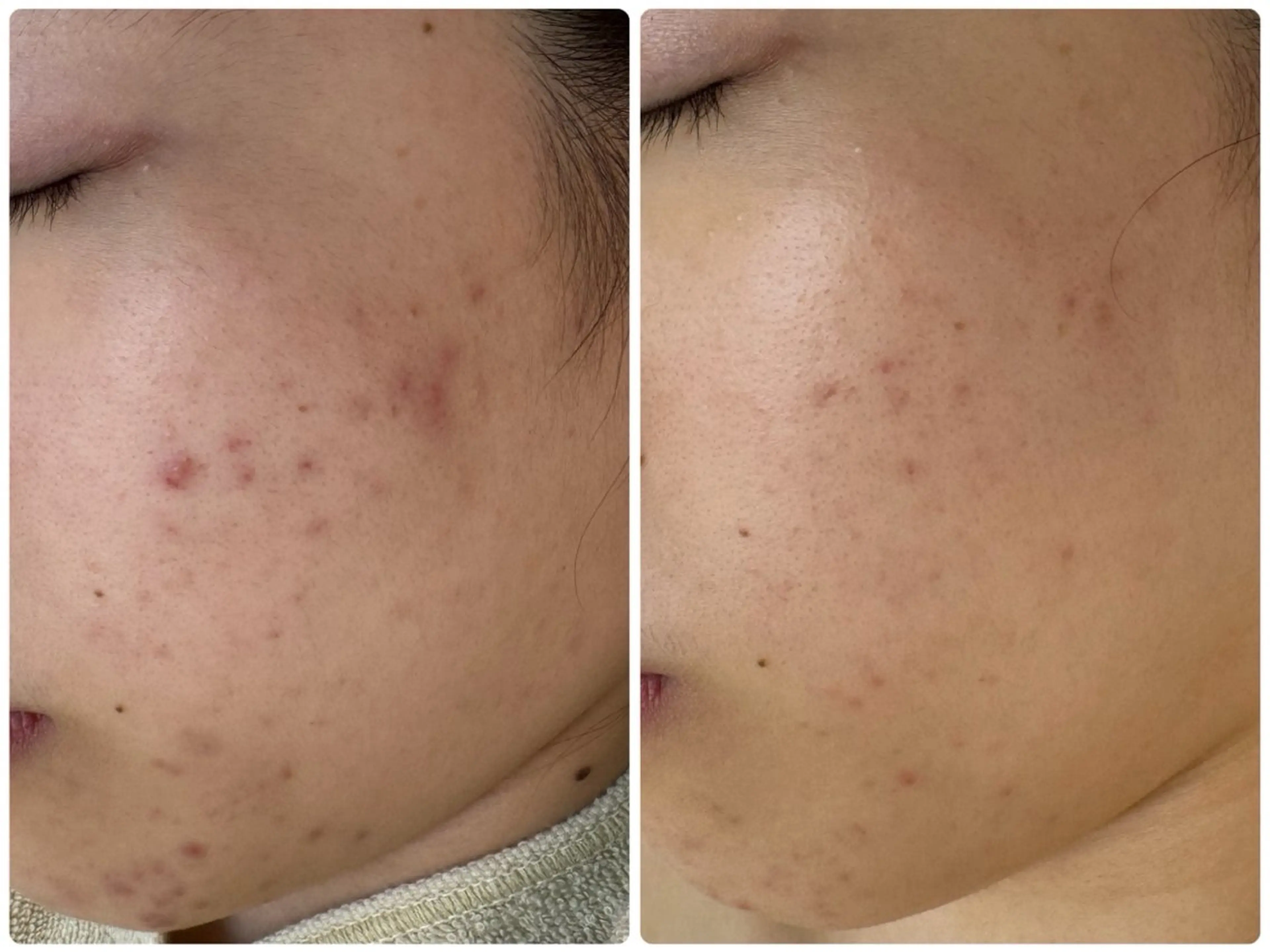 【人気No.2】ニキビ ニキビ跡 毛穴 どんなお悩みの方も◎剥けないハーブピーリング 90分 ¥25300→¥9800の写真