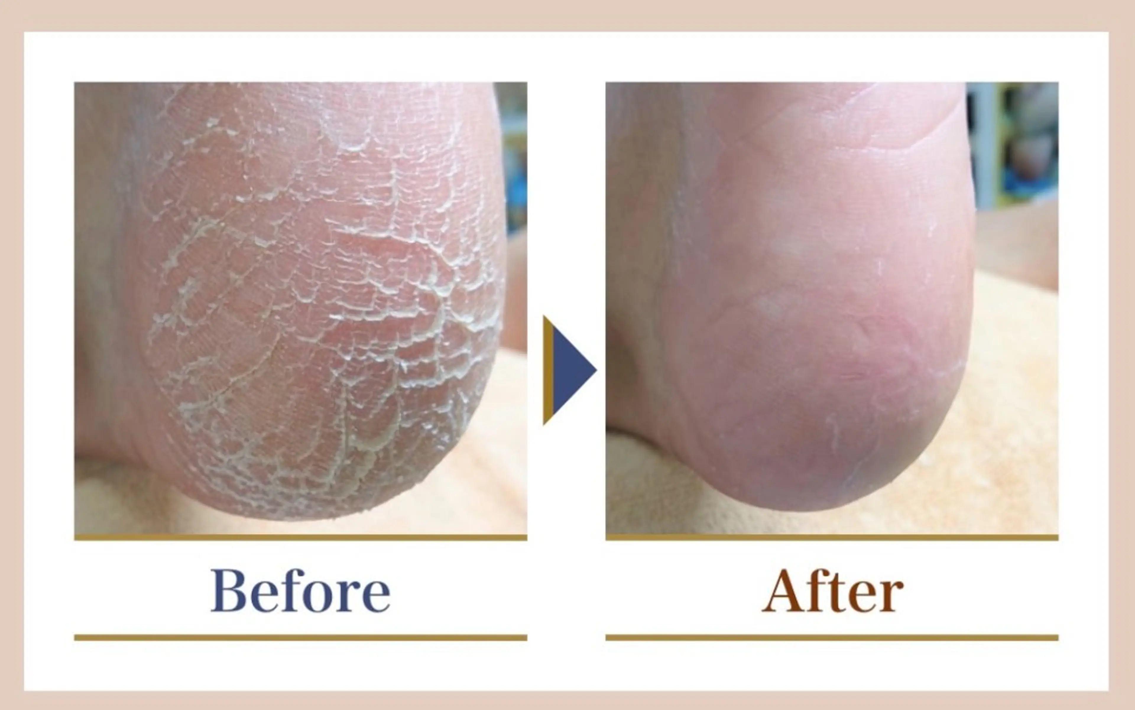 人気No.1[新規限定]【トータル足裏角質】+【爪切りセット】 ¥9,900→¥8,250の写真