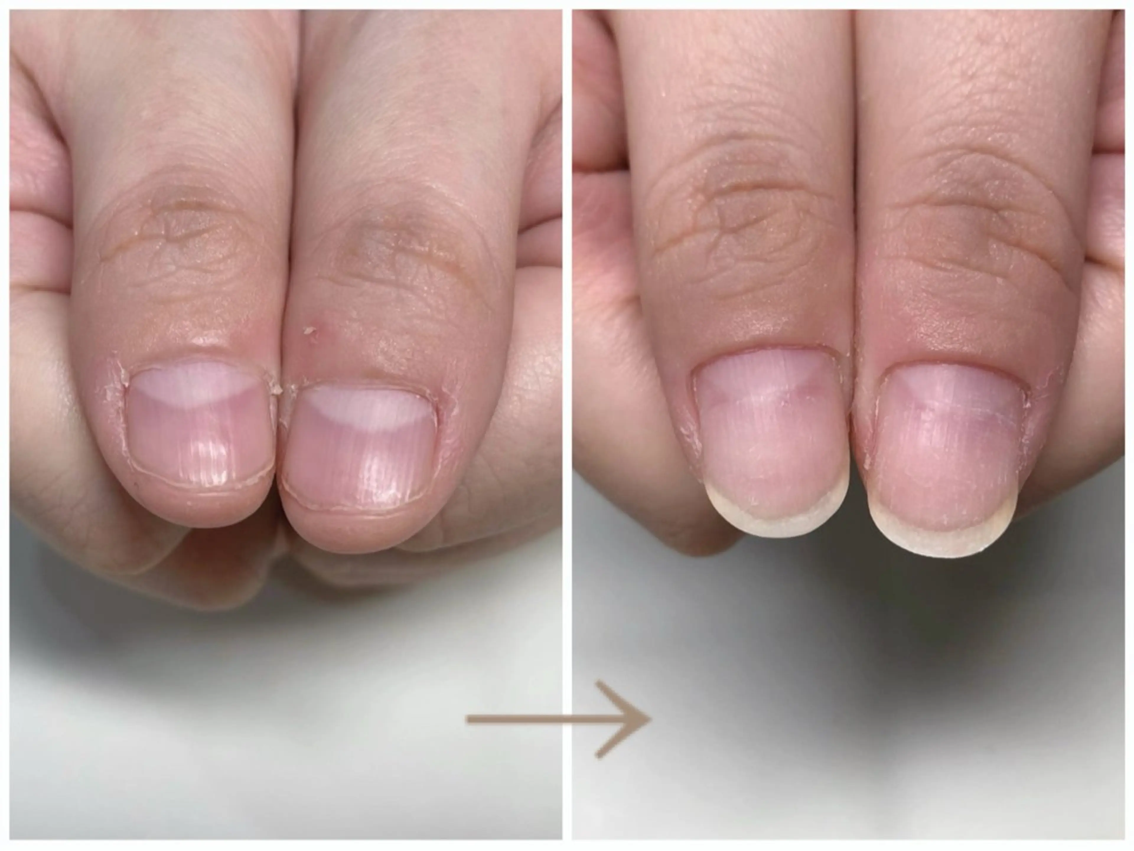 ネイル ピンク 深爪矯正・自爪育成 ヴェールリムのネイルデザイン