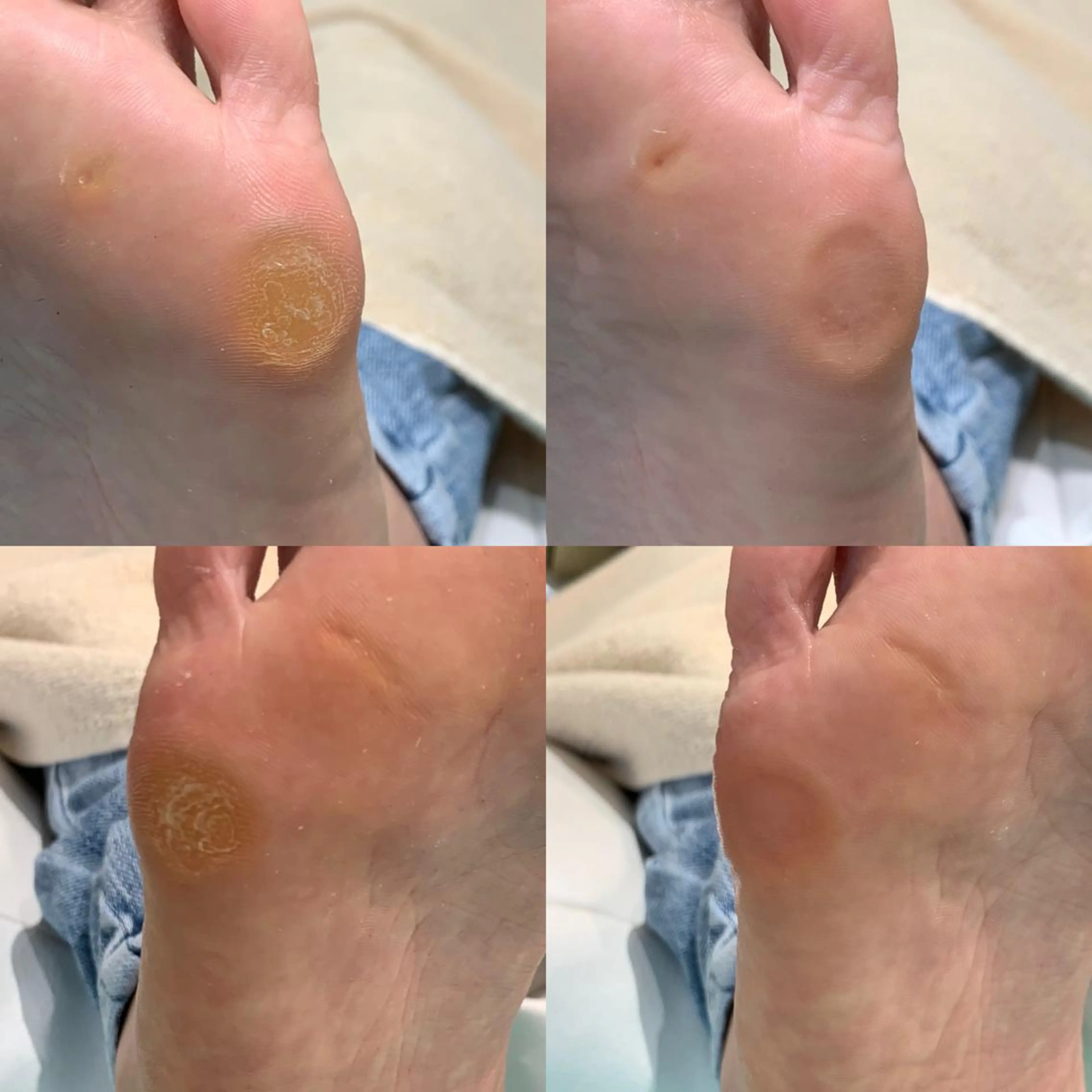 【足裏タコケア​〜​】朗報✨【🉐2回目以降もずっと"施術料が500円🉐】足裏にできたゴワゴワ🌀角質もスベスベの足裏に✨の写真