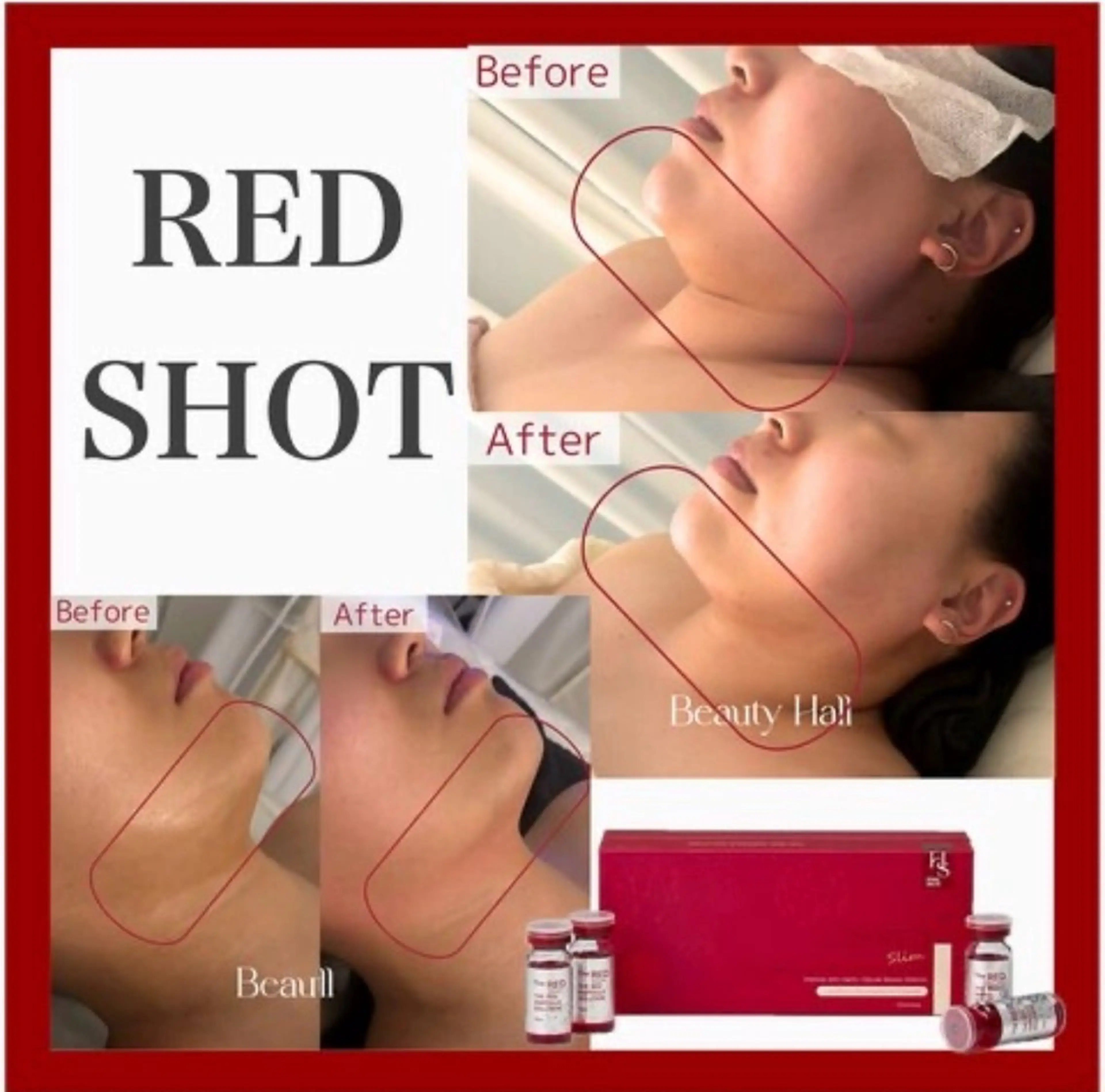 韓国美容【レッドショット】🔥脂肪撃退🔥小顔効果抜群！いらない脂肪はサヨウナラ👋🏻の写真