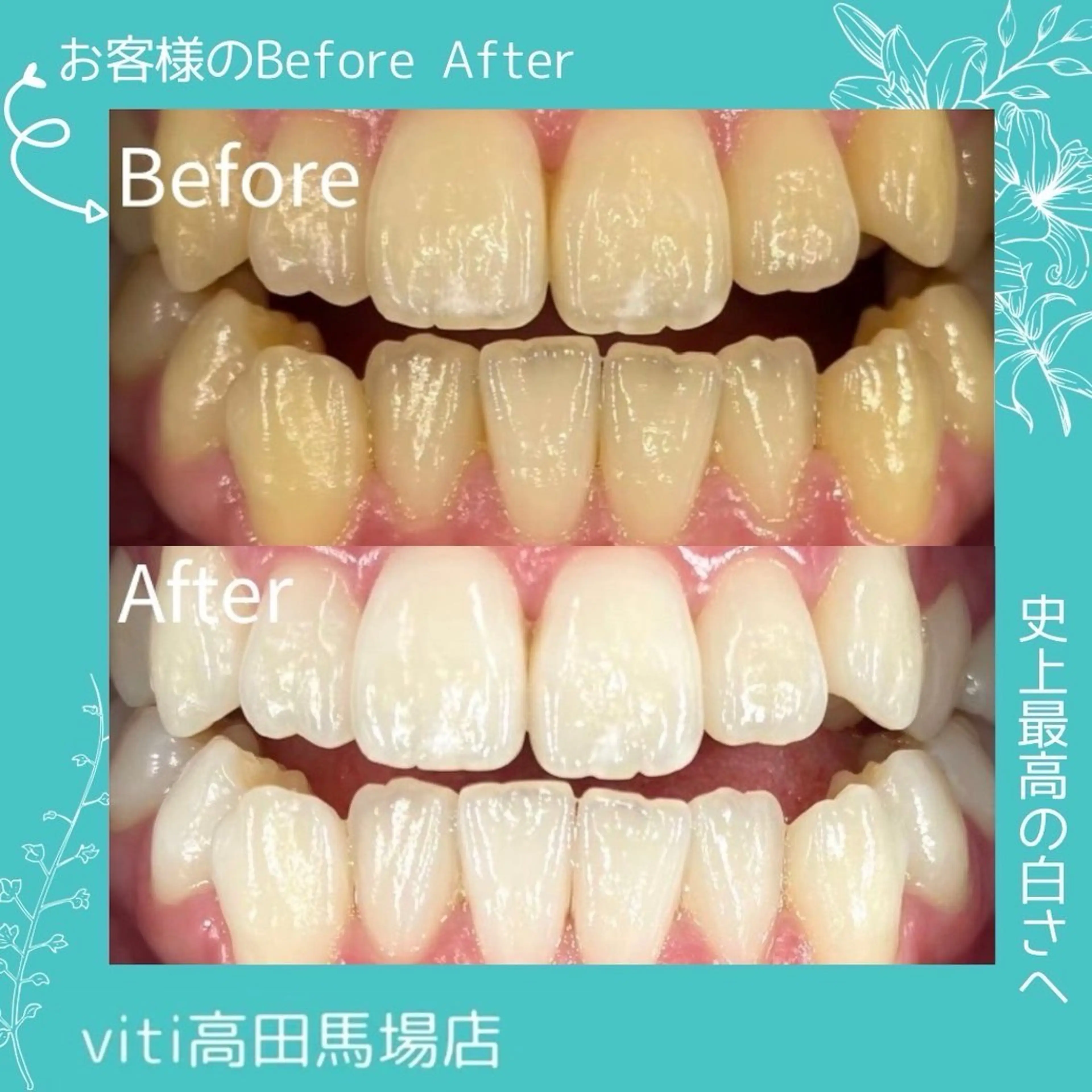 💙美容💙セルフホワイトニング30分+カウンセリングの写真