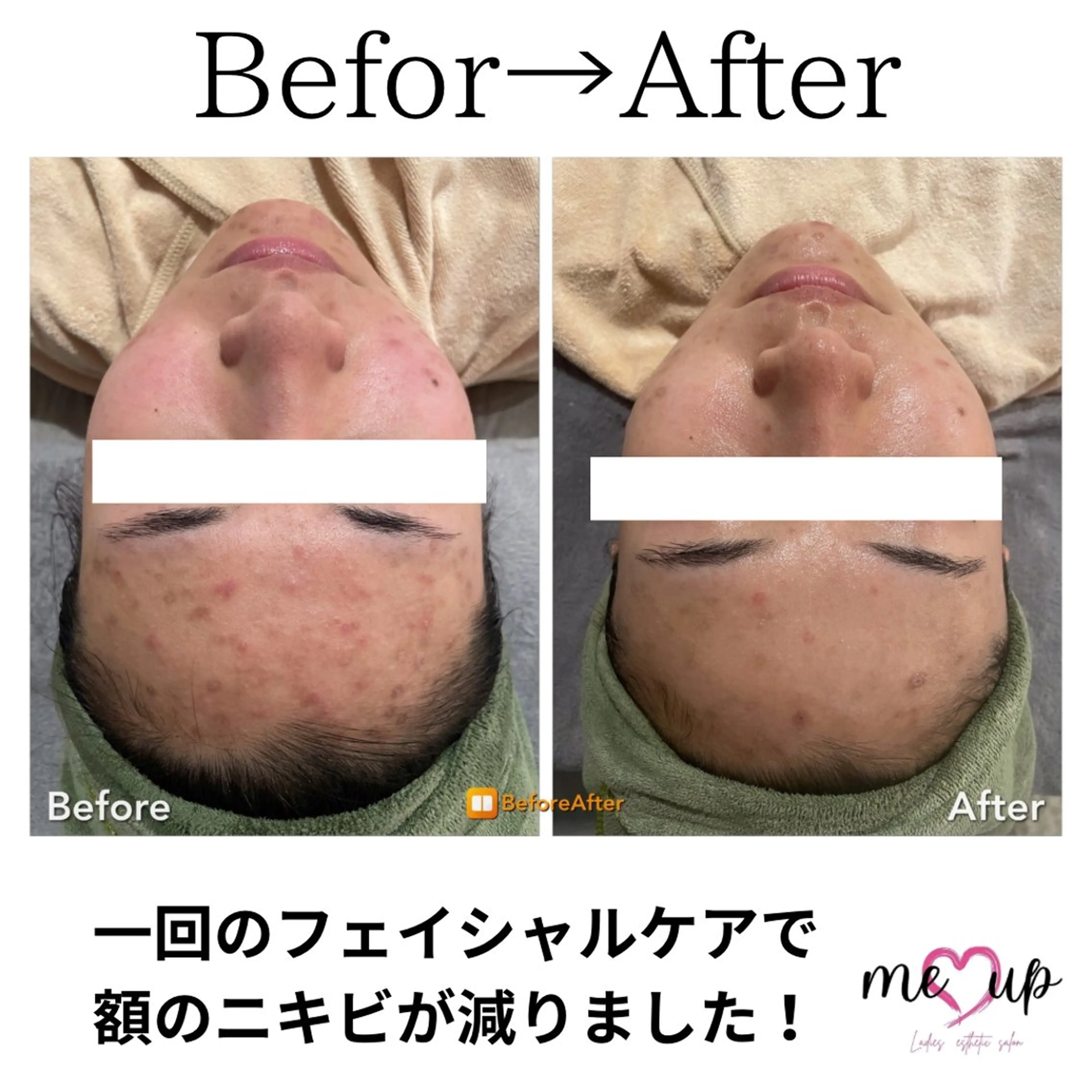 Meupニキビ専門店 背中/ハーブ/肌管理のその他イメージ