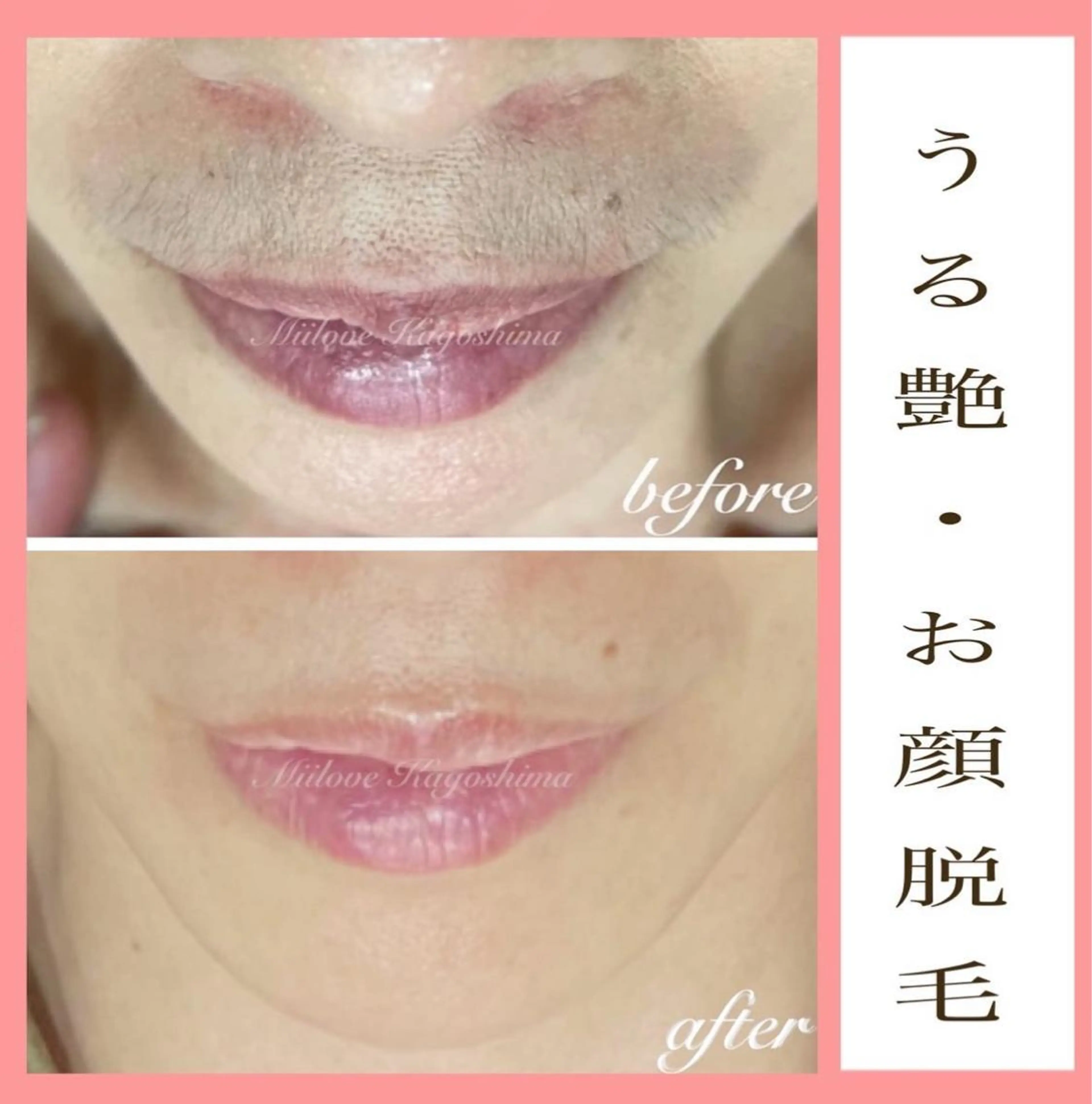 脱毛 miilove 鹿児島店のエステ・リラクイメージ