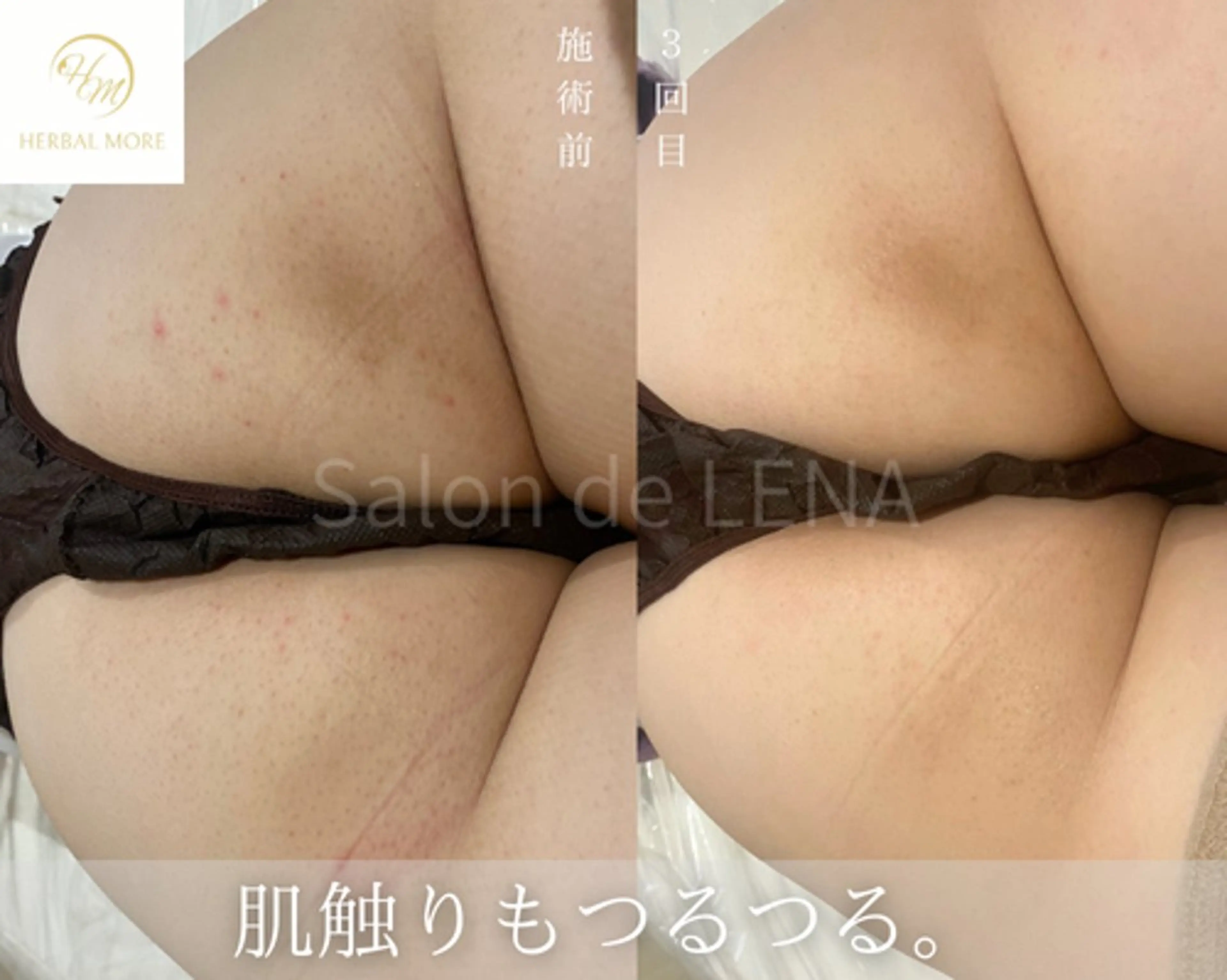 【お尻ハーブピーリング/剥離有・無】の写真