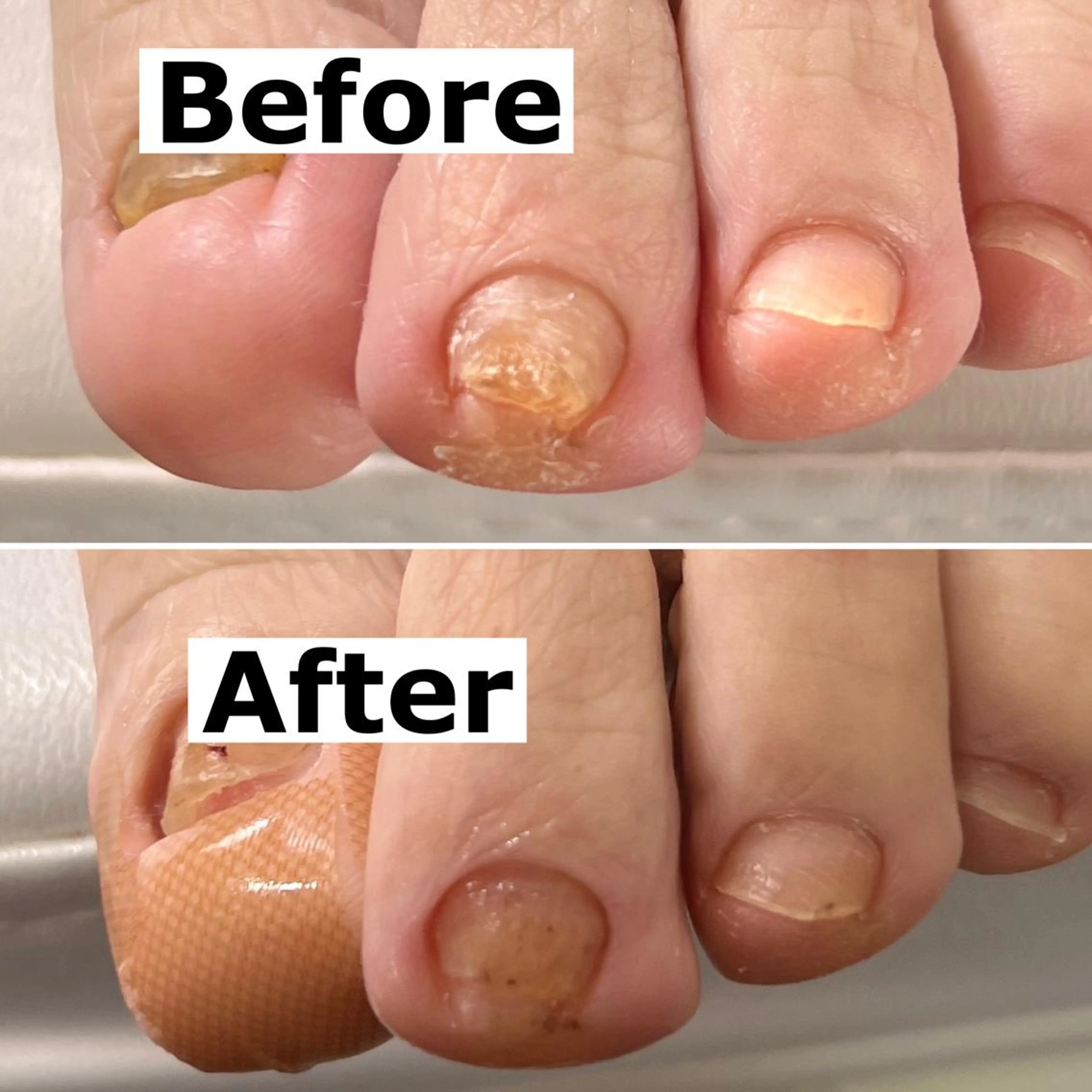 ネイル 巻爪無料モデル募集 ✨🦶MEGUMIのネイルデザイン