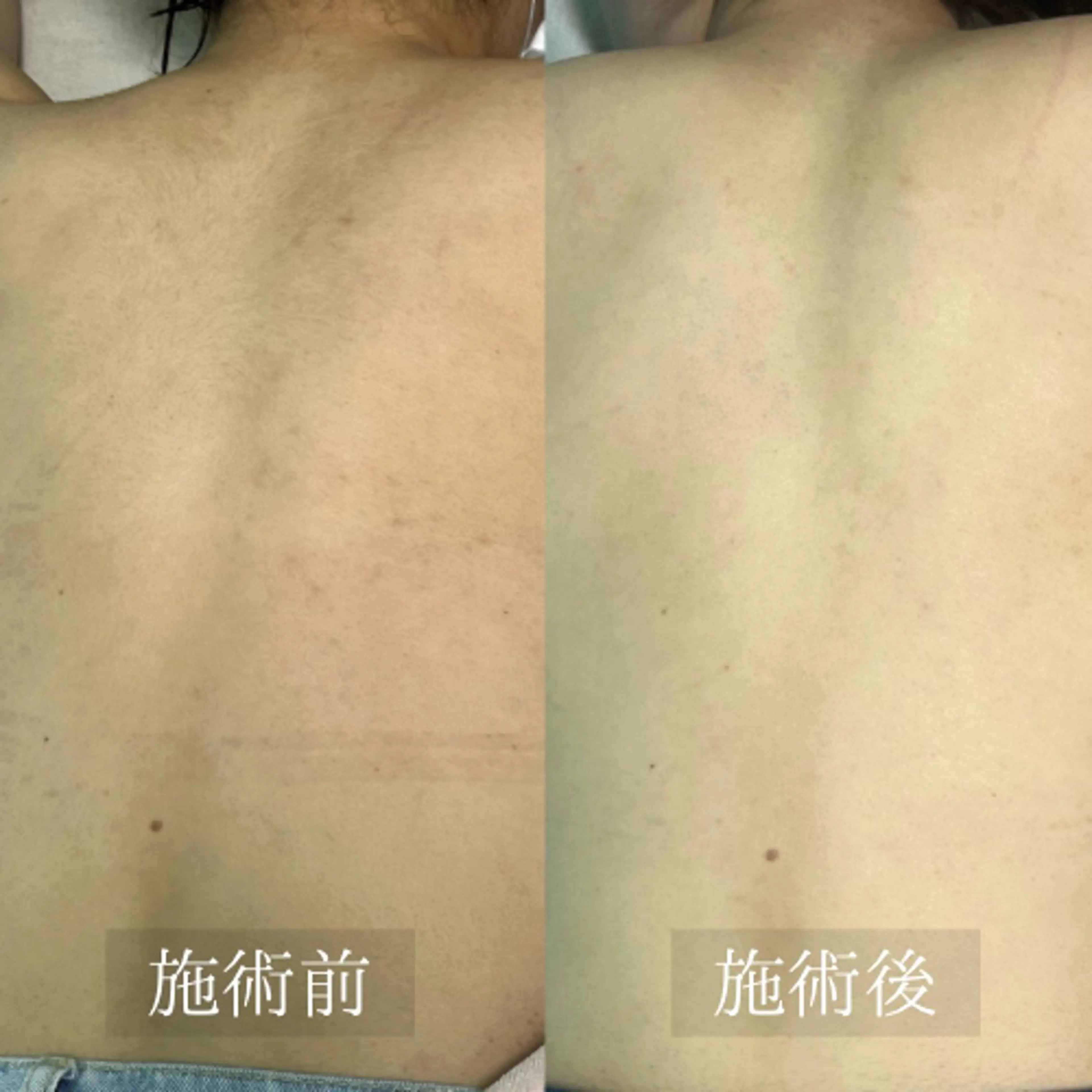 【4月限定✨】部分脱毛　無料の写真