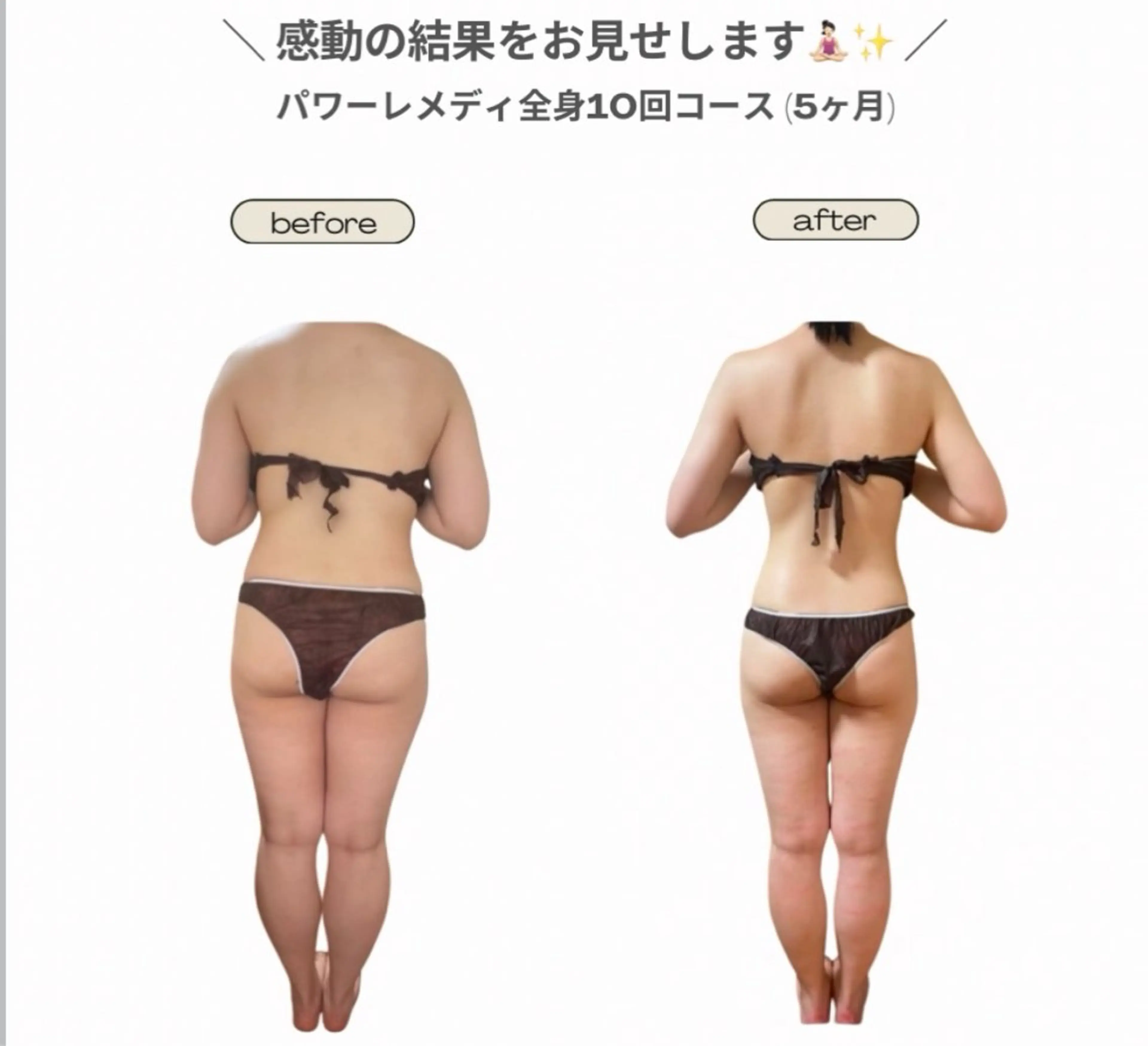 《biloop式筋膜痩身10回コース🌿》本気痩せ＆身体改革✨（1回あたり11,000円）の写真