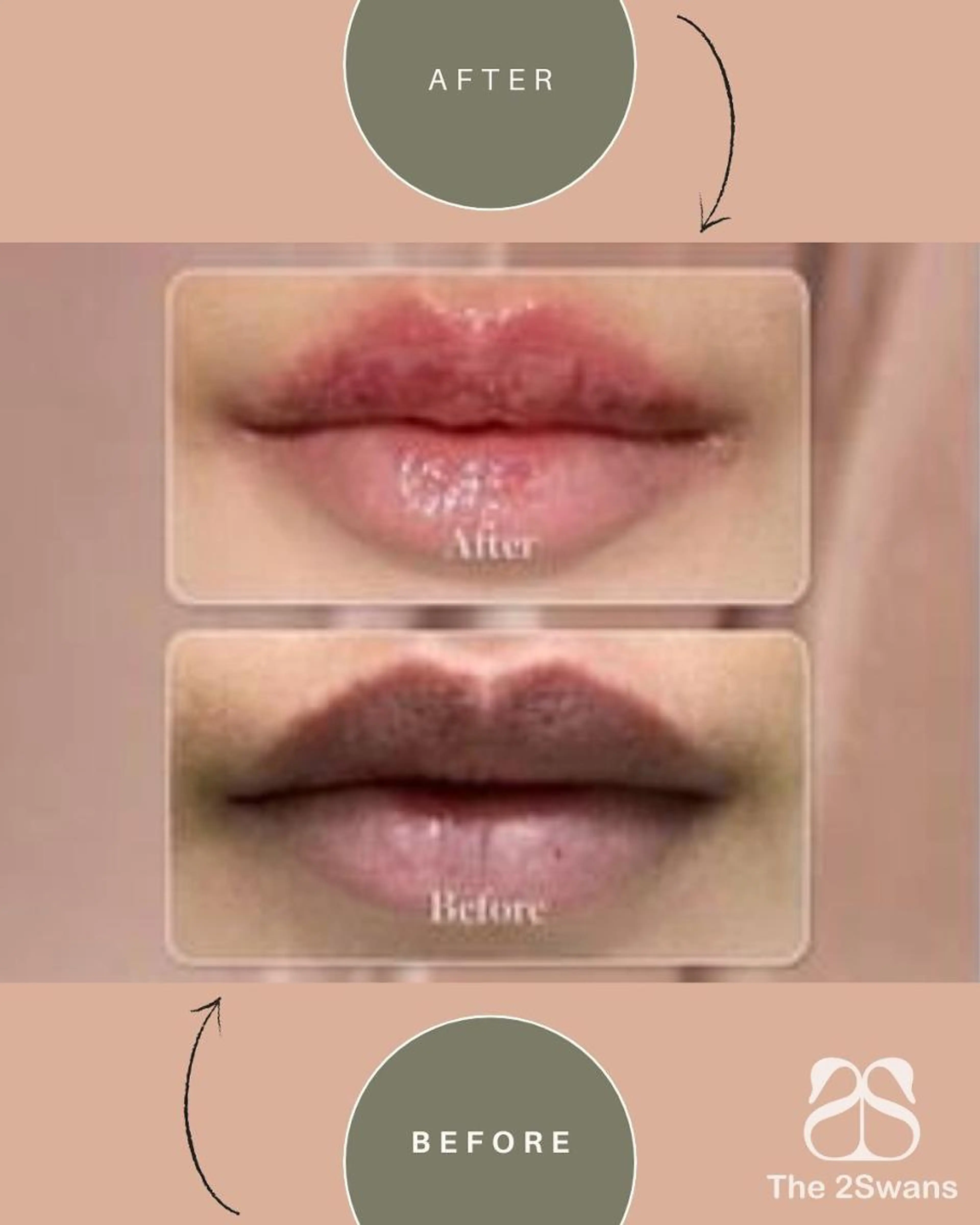 【韓国正規取扱サロン Lemella ルメラ】ピンクに~唇 黒ずみメラニンケアの写真