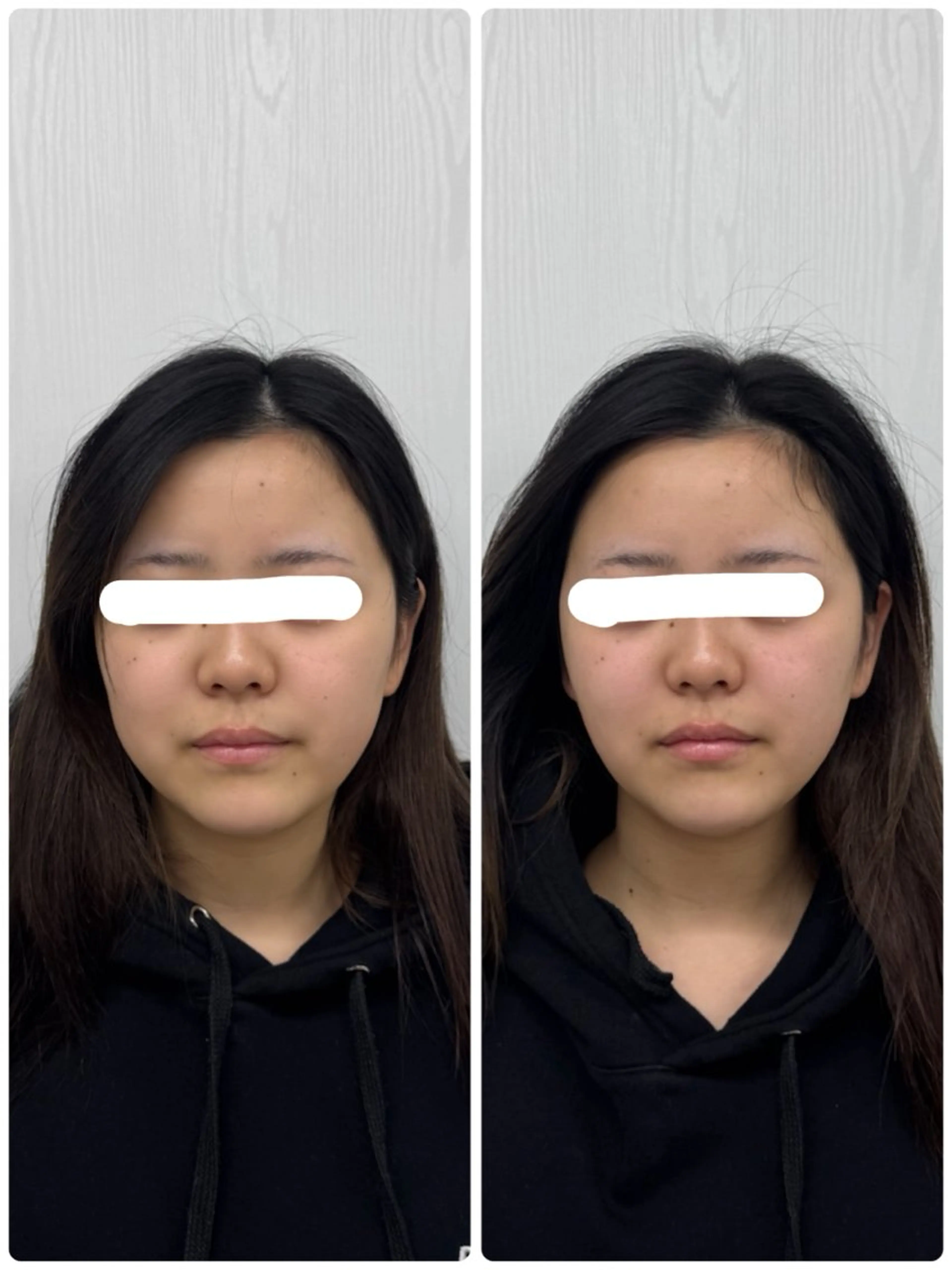 美容鍼×小顔矯正 ×美容整体　浜川泰仁のエステ・リラクイメージ