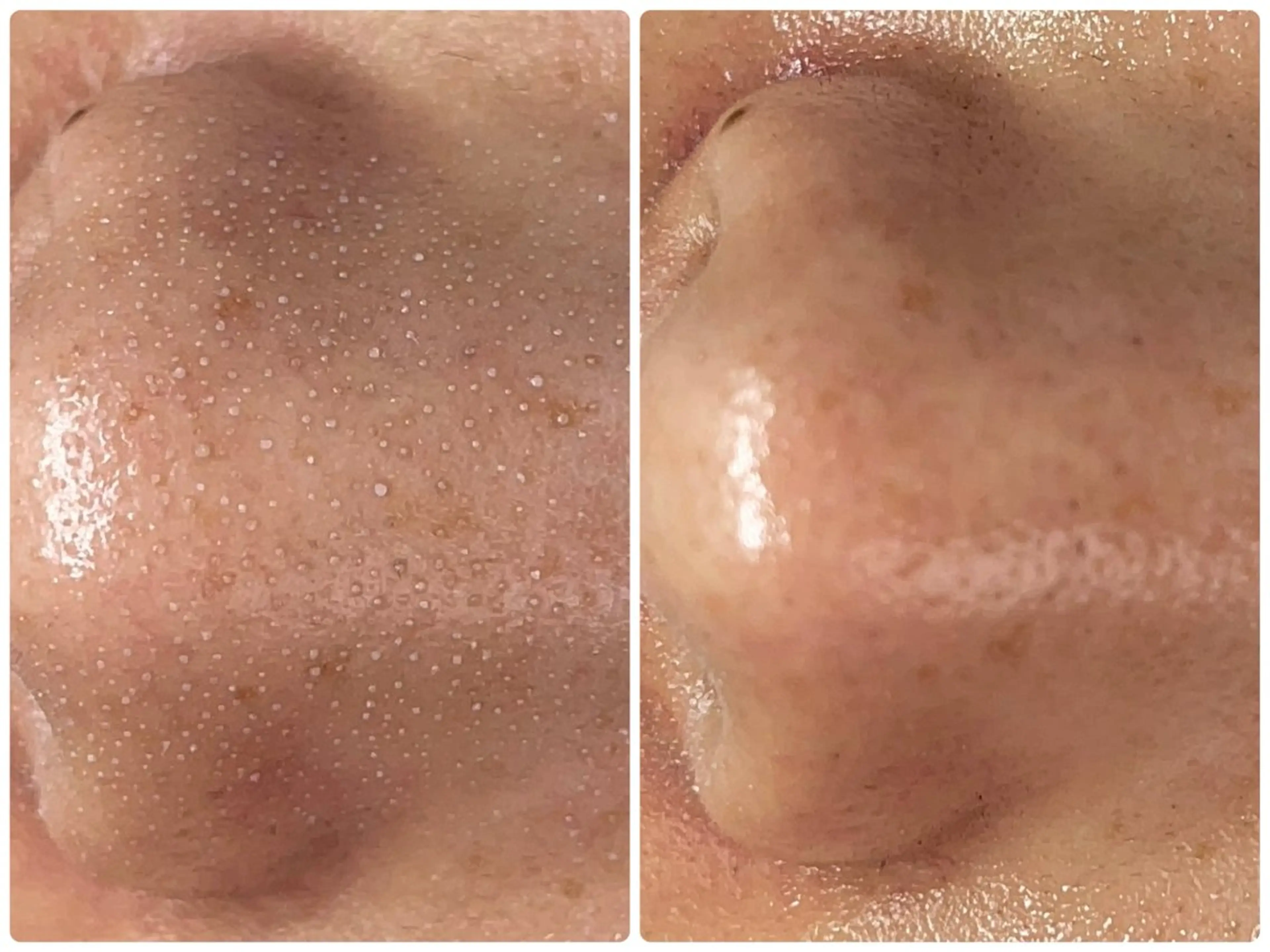 エステ REVI取扱・肌悩み 毛穴Chalonのエステ・リラクイメージ