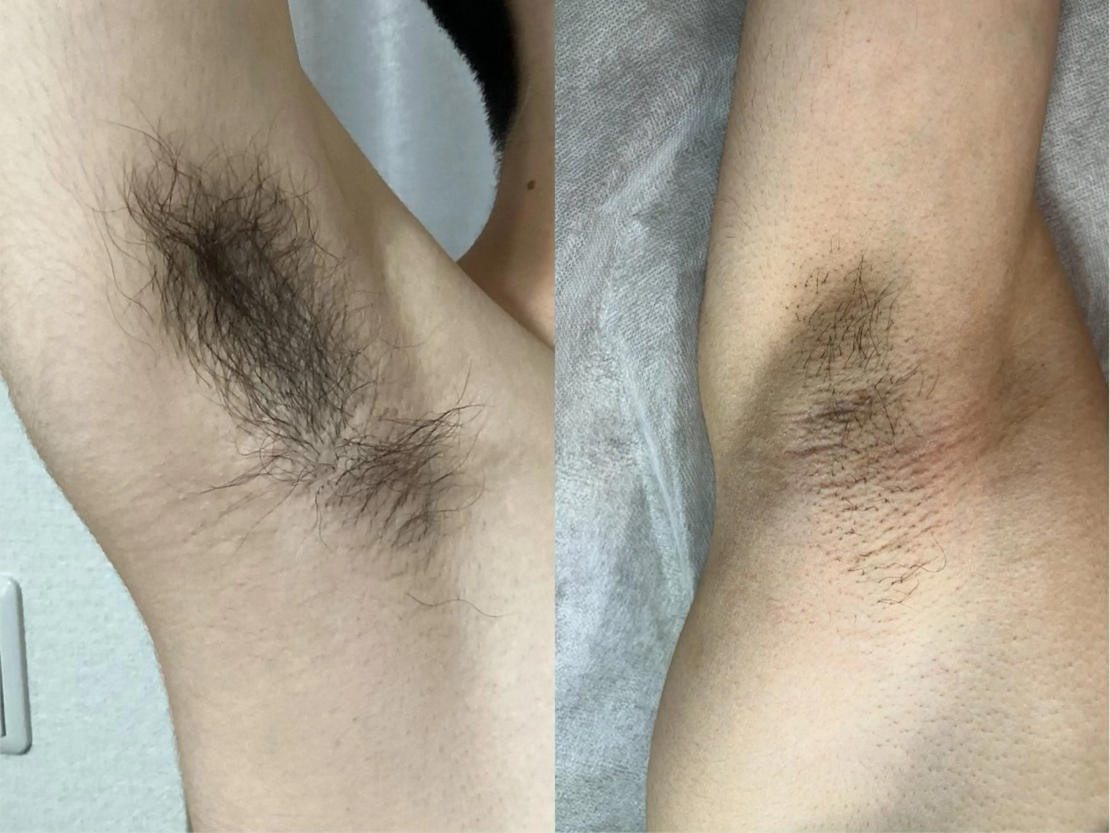 男女　ワキ脱毛の写真
