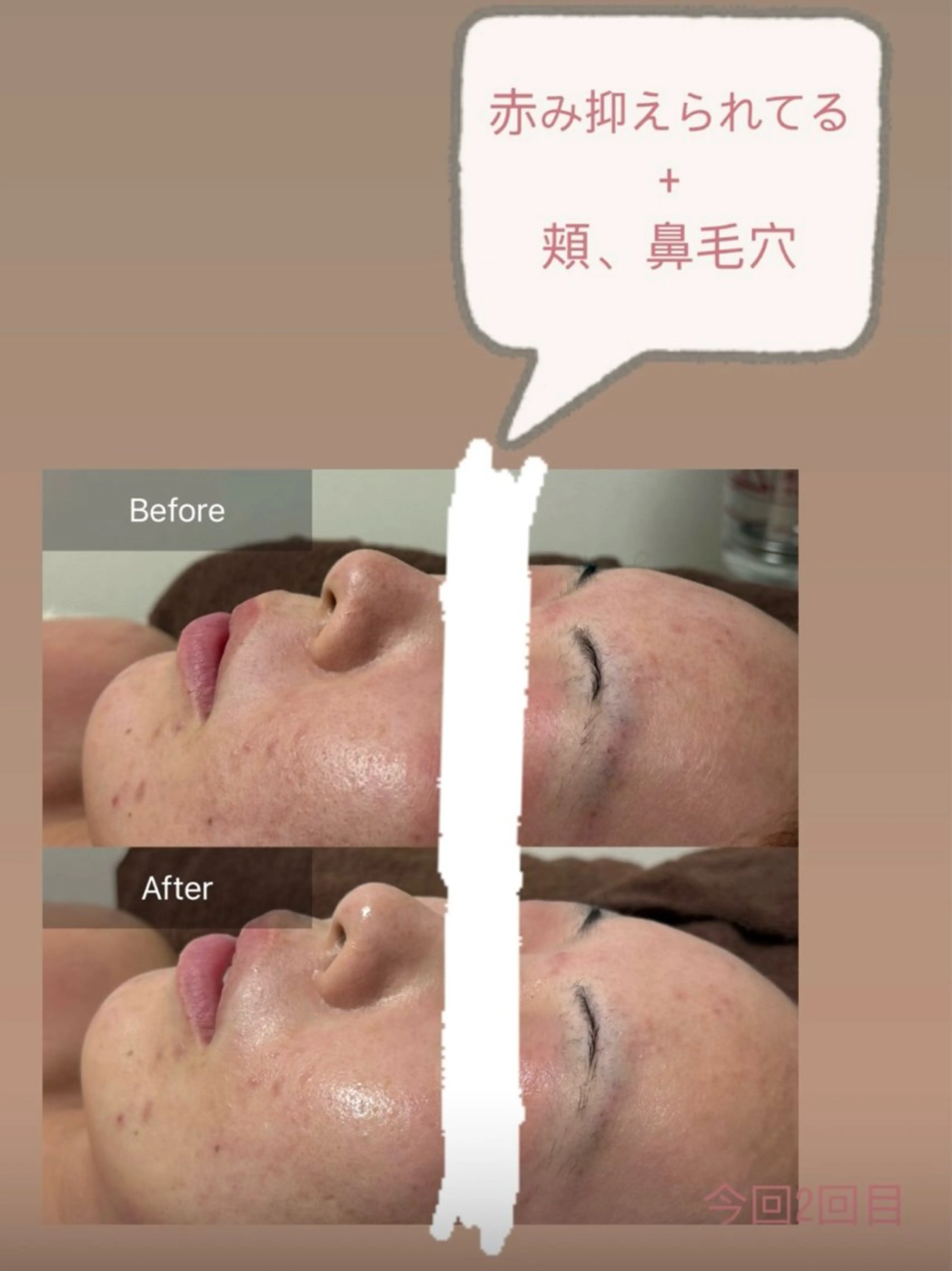 天使の艶肌　REVIハーブピーリング＆ヘッドスパ 武蔵小杉店所属・天使の 艶肌のエステ・リラクイメージ