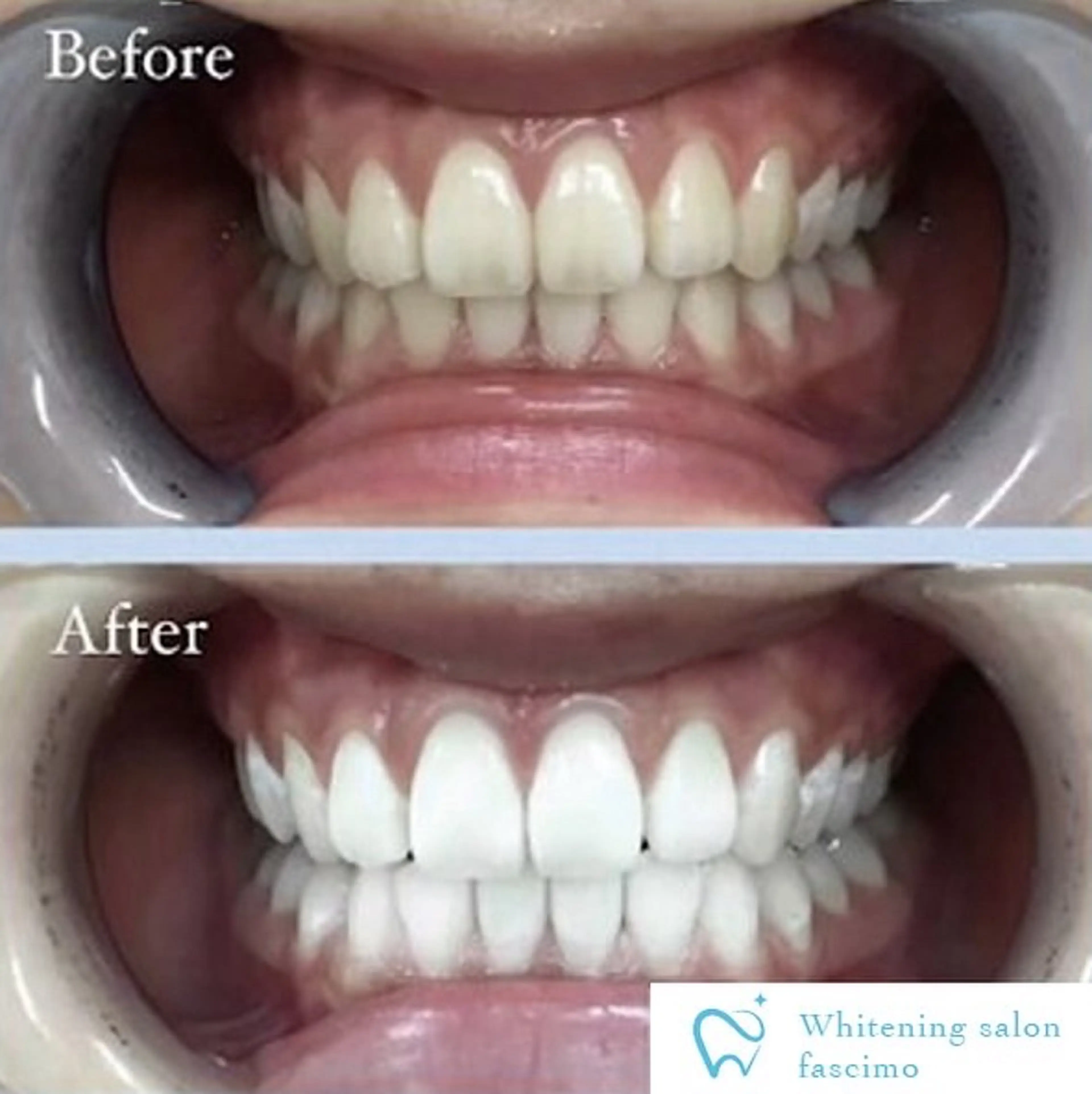 【初回限定】8分×2回照射💡セルフホワイトニング6,600円→2,970円🫧効果実感高いパープルライト使用‼️の写真