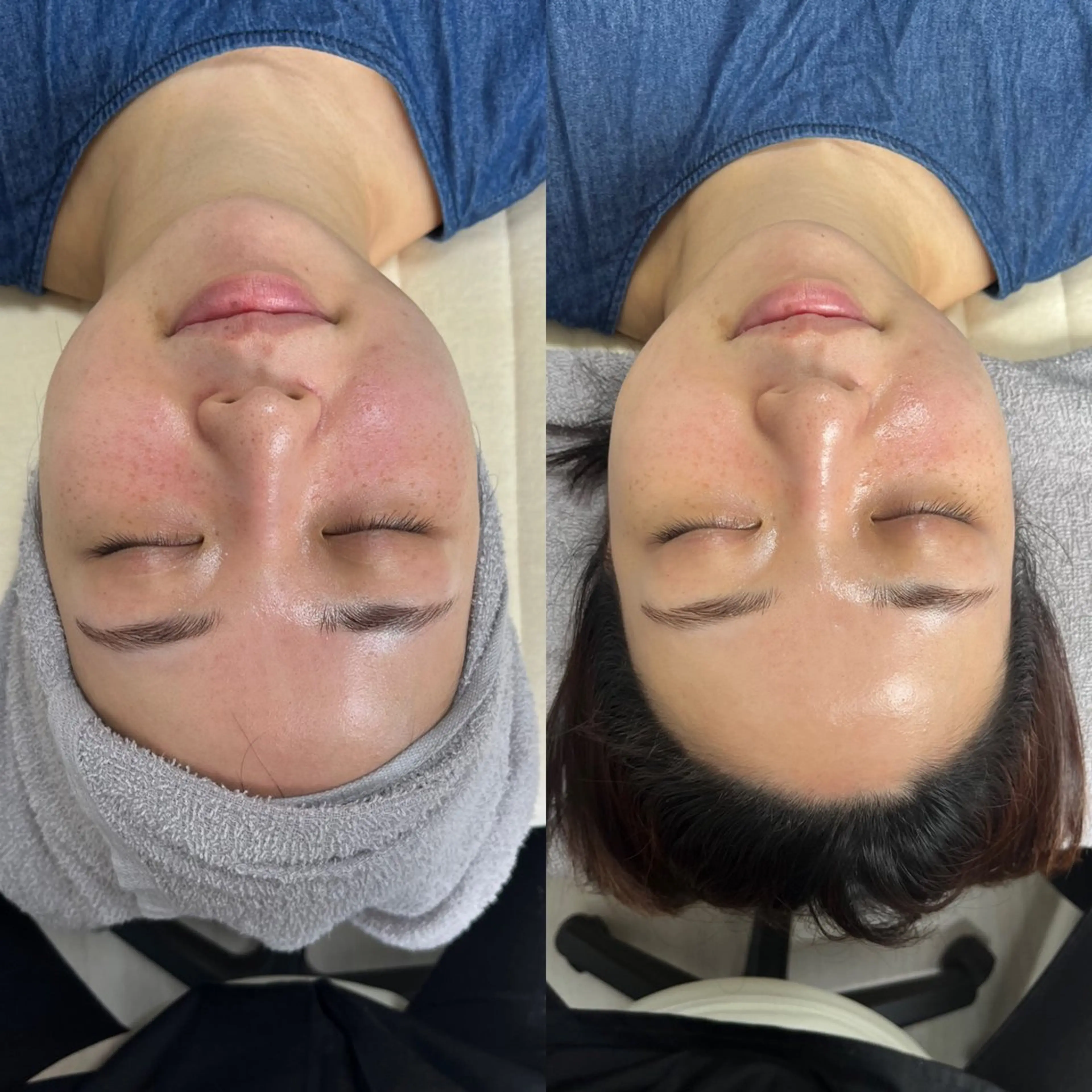 顔の赤みが気になる方!ヒト幹細胞培養液導入エステ💆♀️✨の写真